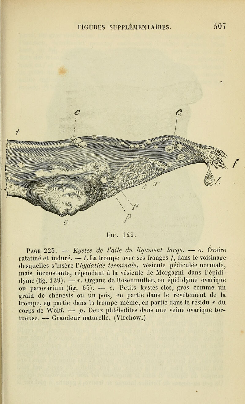 / FiG. 'U2. Page 225. — Kystes de Vaile du ligament large. — o. Ovaire ratatiné et induré. — f. La trompe avec ses franges f, dans le voisinage desquelles s'insère Vhydatide terminale, vésicule pédiculée normale^ mais inconstante^ répondant à la vésicule de Morgagni dans l'épidi- dynie (fig. 139). — r. Organe de RosenmûUer, ou épididyme ovarique ou parovarium (fig. 65). — c. Petits kystes clos^ gros comme un grain de chêne vis ou un pois^ en partie dans le revêtement de la trompe^ eu partie dans la trompe même^ en partie dans le résidu r du corps de Wolff. — p. Deux phlébolites dans une veine ovarique tor- tueuse. — Grandeur naturelle. (Virchow.)