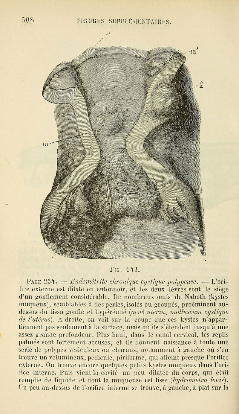 FiG. 143. Page 254. — Endojnétrite chronique cysilque polypeuse. — L'ori- fiie externe est dilaté en entonnoir^ et les deux lèvres sont le siège d'un gonflement considérable. De nombreux œufs de Naboth (kystes muqueux), semblables à des perles, isolés ou groupés^ proéminent au- dessus du tissu gonflé et hypérémié {acné utéi-in^ molluscum cystique de l'utérus). A droite, on voit sur la coupe que ces kystes n'appar- tiennent pas seulement à la surface, mais qu'ils s'étendent jusqu'à une assez grande profondeur. Plus haut_, dans le canal cervical, les replis palmés sont fortement accusés, et ils donnent naissance à toute une série de polypes vésiculeux ou charnus, notamment à gauche où s'en trouve un volumineux, pédicule, piriforme, qui atteint presque l'orifice externe. On trouve encore quelques petits kystes nmqueux dans Tori- fîce interne. Puis vient la cavité un peu dilatée du corps, qui était remplie de liquide et dont la muqueuse est lisse {hydro)7ietra levis). Un peu au-dessus de l'orifice interne se trouve, à gauche, à plat sur la