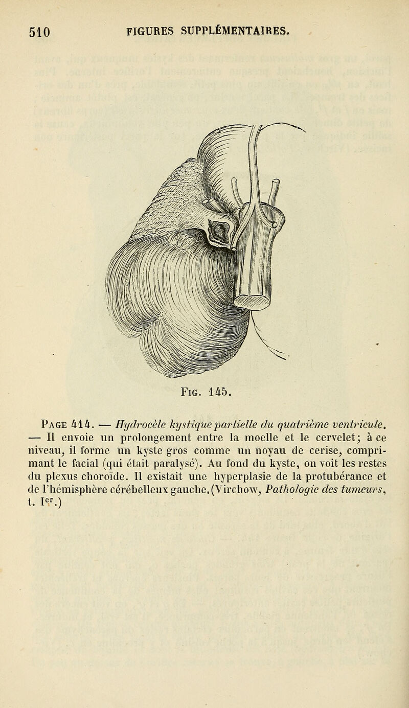 FiG. 145. Page 414. — Hydrocèle kystique partielle du quatrième ventricule. — Il envoie un prolongement entre la moelle et le cervelet; à ce niveau, il forme un kyste gros comme un noyau de cerise, compri- mant le facial (qui était paralysé). Au fond du kyste, on voit les restes du plexus choroïde. Il existait une hyperplasie de la protubérance et de l'hémisphère cérébelleux gauche. (Virchow, Pathologie des tumeurs^ t. I^T.)