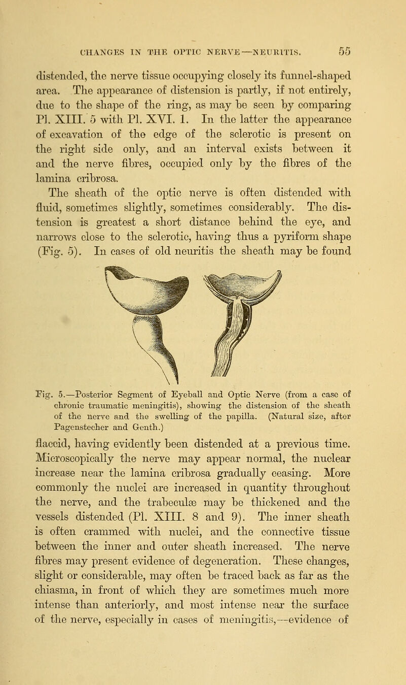 distended, the nerve tissue occupying closely its funnel-shaped area. The appearance of distension is partly, if not entirely, due to the shape of the ring, as may be seen by comparing PI. XIII. 5 with PI. XVI. 1. In the latter the appearance of excavation of the edge of the sclerotic is present on the right side only, and an interval exists between it and the nerve fibres, occupied only by the fibres of the lamina cribrosa. The sheath of the optic nerve is often distended with fluid, sometimes slightly, sometimes considerably. The dis- tension is greatest a short distance behind the eye, and narrows close to the sclerotic, having thus a pyriform shape (Fig. 5). In cases of old neuritis the sheath may be found Fig. 5.—Posterior Segment of Eyeball and Optic Nerve (from a case of chronic traumatic meningitis), showing the distension of the sheath of the nerve and the swelling of the papilla. (Natural size, after Pagenstecher and Genth.) flaccid, having evidently been distended at a previous time. Microscopically the nerve may appear normal, the nuclear increase near the lamina cribrosa gradually ceasing. More commonly the nuclei are increased in quantity throughout the nerve, and the trabeculse may be thickened and the vessels distended (PI. XIII. 8 and 9). The inner sheath is often crammed with nuclei, and the connective tissue between the inner and outer sheath increased. The nerve fibres may present evidence of degeneration. These changes, slight or considerable, may often be traced back as far as the chiasma, in front of which they are sometimes much more intense than anteriorly, and most intense near the surface of the nerve, especially in cases of meningitis,—evidence of