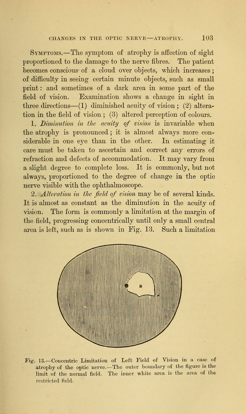 Symptoms.—The symptom of atrophy is affection of sight proportioned to the damage to the nerve fibres. The patient becomes conscions of a cloud over objects, which increases; of difficulty in seeing certain minute objects, such as small print: and sometimes of a dark area in some part of the field of vision. Examination shows a change in sight in three directions—(1) diminished acuity of vision ; (2) altera- tion in the field of vision ; (3) altered perception of colours. 1. Diminution in the acuity of vision is invariable when the atrophy is pronounced; it is almost always more con- siderable in one eye than in the other. In estimating it care must be taken to ascertain and correct any errors of refraction and defects of accommodation. It may vary from a slight degree to complete loss. It is commonly, but not always, proportioned to the degree of change in the optic nerve visible with the ophthalmoscope. 2. Alteration in the field of vision may be of several kinds. It is almost as constant as the diminution in the acuity of vision. The form is commonly a limitation at the margin of the field, progressing concentrically until only a small central area is left, such as is shown in Fig. 13. Such a limitation Fig. 13.—Concentric Limitation of Left Field of Vision in a case of atrophy of the optic nerve.—The outer boundary of the figure is the limit of the normal field. The inner white area is the area of the restricted field.