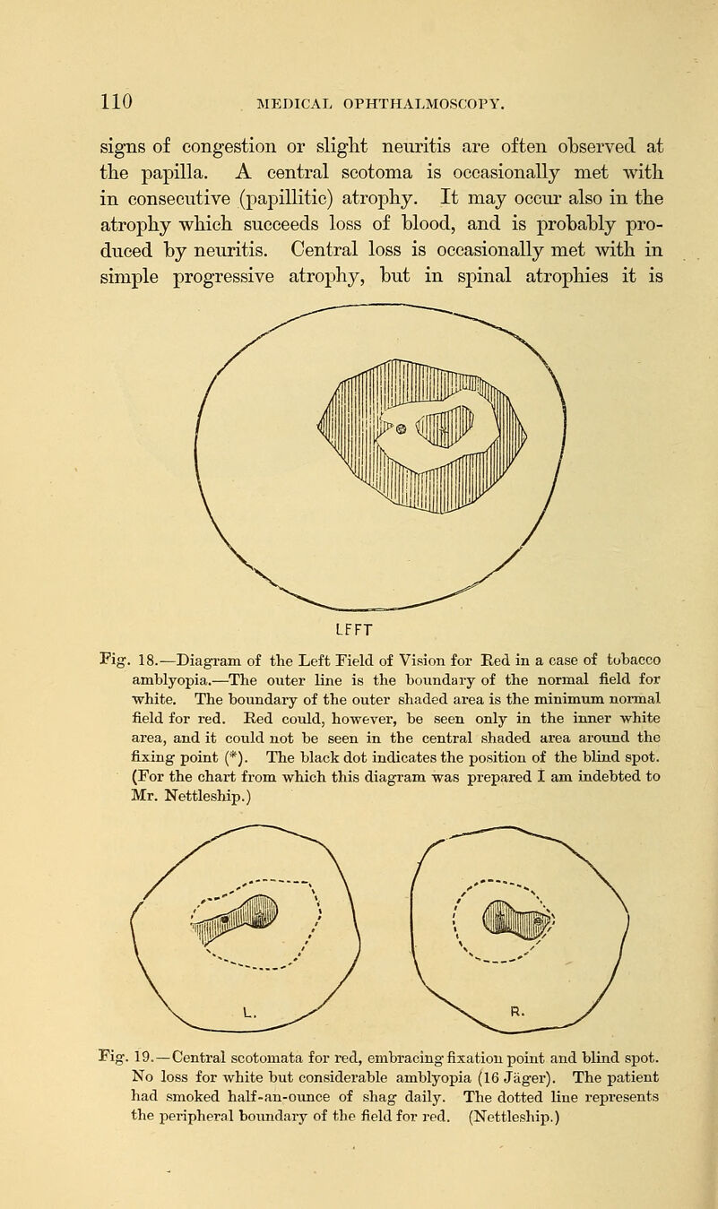 signs of congestion or slight neuritis are often observed at the papilla. A central scotoma is occasionally met with in consecutive (papillitic) atrophy. It may occur also in the atrophy which succeeds loss of blood, and is probably pro- duced by neuritis. Central loss is occasionally met with in simple progressive atrophy, but in spinal atrophies it is LFFT Fig. 18.—Diagram of the Left Field of Vision for Red in a case of tobacco amblyopia.—The outer line is the boundary of the normal field for white. The boundary of the outer shaded area is the minimum normal field for red. Red could, however, be seen only in the inner white area, and it could not be seen in the central shaded area around the fixing point (*). The black dot indicates the position of the blind spot. (For the chart from which this diagram was prepared I am indebted to Mr. Nettleship.) Fig. 19. — Central scotomata for red, embracing fixation point and blind spot. No loss for white but considerable amblyopia (16 Jager). The patient had smoked half-an-ounce of shag daily. The dotted line represents the peripheral boundary of the field for red. (Nettleship.)