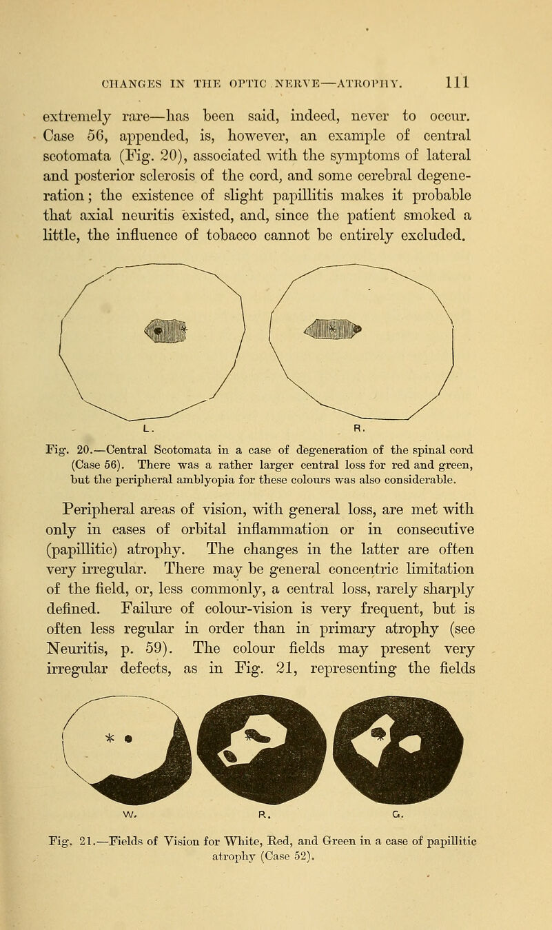 extremely rare—lias been said, indeed, never to occur. Case 56, appended, is, however, an example of central seotomata (Fig. 20), associated with the symptoms of lateral and posterior sclerosis of the cord, and some cerebral degene- ration ; the existence of slight papillitis makes it probable that axial neuritis existed, and, since the patient smoked a little, the influence of tobacco cannot be entirely excluded. Fig. 20.—Central Seotomata in a case of degeneration of the spinal cord (Case 56). There was a rather larger central loss for red and green, but the peripheral amblyopia for these colours was also considerable. Peripheral areas of vision, with general loss, are met with only in cases of orbital inflammation or in consecutive (papillitic) atrophy. The changes in the latter are often very irregular. There may be general concentric limitation of the field, or, less commonly, a central loss, rarely sharply defined. Failure of colour-vision is very frequent, but is often less regular in order than in primary atrophy (see Neuritis, p. 59). The colour fields may present very irregular defects, as in Fig. 21, representing the fields (^ <*MV Fig, 21.—Fields of Vision for White, Red, and Green in a case of papillitic atrophy (Case 52).