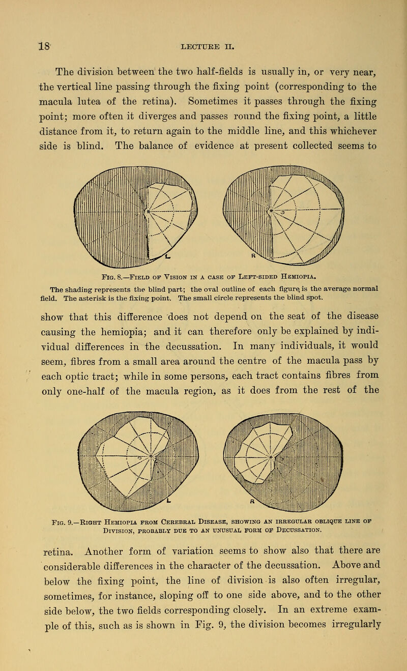 The division between the two half-fields is usually in, or very near, the vertical line passing through the fixing point (corresponding to the macula lutea of the retina). Sometimes it passes through the fixing point; more often it diverges and passes round the fixing point, a little distance from it, to return again to the middle line, and this whichever side is blind. The balance of evidence at present collected seems to Fig. 8.—Field of Vision in a case of Left-sided HaMioPiA. The shading represents the blind part; the oval outline o£ each figure, is the average normal field. The asterisk is the fixing point. The small circle represents the blind spot. show that this difference does not depend on the seat of the disease causing the hemiopia; and it can therefore only be explained by indi- vidual differences in the decussation. In many individuals, it would seem, fibres from a small area around the centre of the macula pass by each optic tract; while in some persons, each tract contains fibres from only one-half of the macula region, as it does from the rest of the Fig. 9.—Right Hemiopia from Cerebral Disease, showing an irregular oblique line of Division, probably due to an unusual form of Decussation. retina. Another form of variation seems to show also that there are considerable differences in the character of the decussation. Above and below the fixing point, the line of division is also often irregular, sometimes, for instance, sloping off to one side above, and to the other side below, the two fields corresponding closely. In an extreme exam- ple of this, such as is shown in Fig. 9, the division becomes irregularly