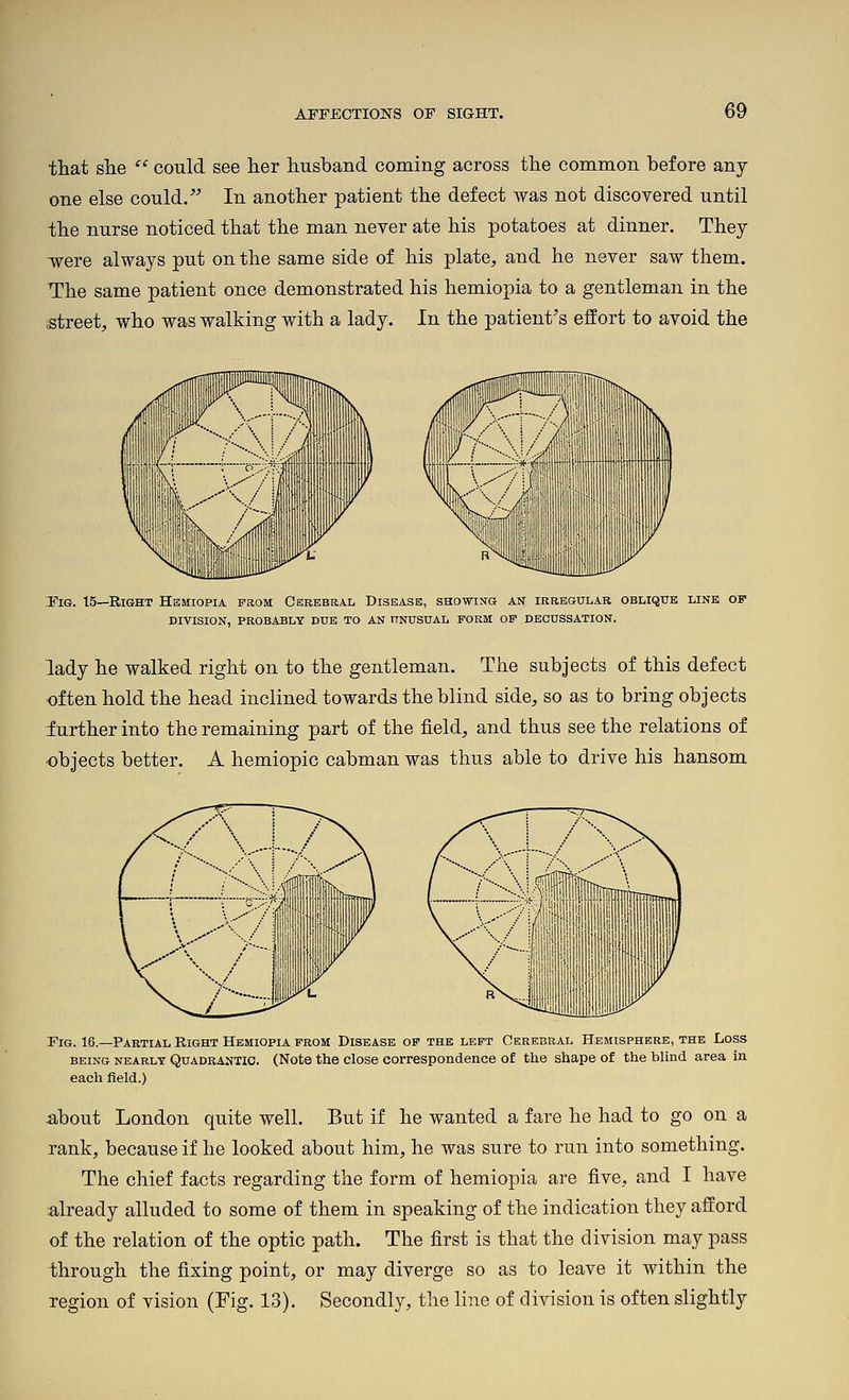 that she  could see her husband coming across the common before any- one else could. In another patient the defect was not discovered until the nurse noticed that the man never ate his potatoes at dinner. They -were always put on the same side of his plate, and he never saw them. The same patient once demonstrated his hemiopia to a gentleman in the street, who was walking with a lady. In the patient's effort to avoid the T'iG. 15—Right Hemiopia from Cerebral Disease, showing an irregular oblique line of DIVISION, PROBABLY DUE TO AN UNUSUAL FORM OF DECUSSATION. lady he walked right on to the gentleman. The subjects of this defect often hold the head inclined towards the blind side, so as to bring objects further into the remaining part of the field, and thus see the relations of objects better. A hemiopic cabman was thus able to drive his hansom Fig. 16.—Partial Right Hemiopia from Disease of the left Cerebral Hemisphere, the Loss BEING NEARLY QuADRANTlC. (Note the closG Correspondence of the shape of the blind area in each field.) about London quite well. But if he wanted a fare he had to go on a rank, because if he looked about him, he was sure to run into something. The chief facts regarding the form of hemiopia are five, and I have already alluded to some of them in speaking of the indication they afford of the relation of the optic path. The first is that the division may pass through the fixing point, or may diverge so as to leave it within the region of vision (Fig. 13). Secondly, the line of division is often slightly