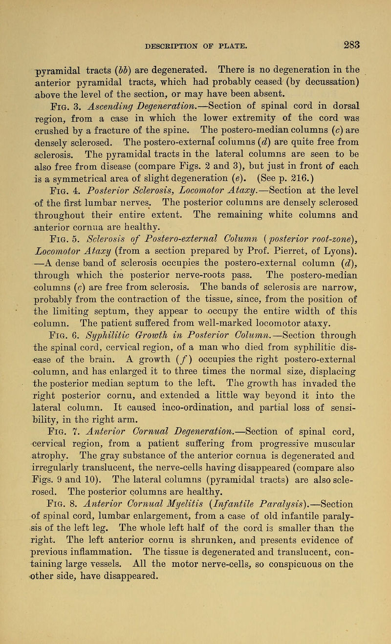 3)yramidal tracts (55) are degenerated. There is no degeneration in the anterior pyramidal tracts, which had probably ceased (by decussation) above the level of the section, or may have been absent. Fig. 3. Ascending Degeneration.—Section of spinal cord in dorsal region, from a case in which the lower extremity of the cord was crushed by a fracture of the spine. The postero-median columns (c) are densely sclerosed. The postero-external columns {d) are quite free from sclerosis. The pyramidal tracts in the lateral columns are seen to be also free from disease (compare Figs. 2 and 3), but just in front of each is a symmetrical area of slight degeneration (e). (See p. 216.) Fig. 4. Posterior Sclerosis, Locomotor Ataxy.—Section at the level of the first lumbar nerves. The posterior columns are densely sclerosed throughout their entire extent. The remaining white columns and anterior cornua are healthy. Fig. 5. Sclerosis of Postero-external Column (posterior root-zone). Locomotor Ataxy (from a section prepared by Prof. Pierret, of Lyons). —A dense band of sclerosis occupies the postero-external column {d), through which the posterior nerve-roots pass. The postero-median columns (c) are free from sclerosis. The bands of sclerosis are narrow, probably from the contraction of the tissue, since, from the position of the limiting septum, they appear to occupy the entire width of this column. The patient suffered from well-marked locomotor ataxy. Fig. 6. Syphilitic Growth in Posterior Column.—Section through the spinal cord, cervical region, of a man who died from syphilitic dis- ease of the brain. A growth (/) occupies the right postero-external column, and has enlarged it to three times the normal size, displacing the posterior median septum to the left. The growth has invaded the right posterior cornu, and extended a little way beyond it into the lateral column. It caused inco-ordination, and partial loss of sensi- bility, in the right arm. Fig. 7. Anterior Cornual Degeneration.—Section of spinal cord, cervical region, from a patient suffering from progressive muscular atrophy. The gray substance of the anterior cornua is degenerated and irregularly translucent, the nerve-cells having disappeared (compare also Figs. 9 and 10). The lateral columns (pyramidal tracts) are also scle- rosed. The posterior columns are healthy. Fig. 8. Anterior Cornual Myelitis {Infantile Paralysis).—Section of spinal cord, lumbar enlargement, from a case of old infantile paraly- sis of the left leg. The whole left half of the cord is smaller than the right. The left anterior cornu is shrunken, and presents evidence of previous inflammation. The tissue is degenerated and translucent, con- taining large vessels. All the motor nerve-cells, so conspicuous on the other side, have disappeared.