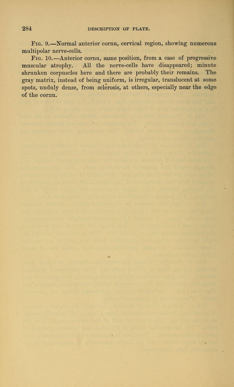 Fig. 9.—Normal anterior cornu, cervical region, showing numerous- multipolar nerve-cells. Fig. 10.—Anterior cornu, same position, from a case of progressive muscular atrophy. All the nerve-cells have disappeared; minuta shrunken corpuscles here and there are probably their remains. The gray matrix, instead of being uniform, is irregular, translucent at some spots, unduly dense, from sclerosis, at others, especially near the edge-