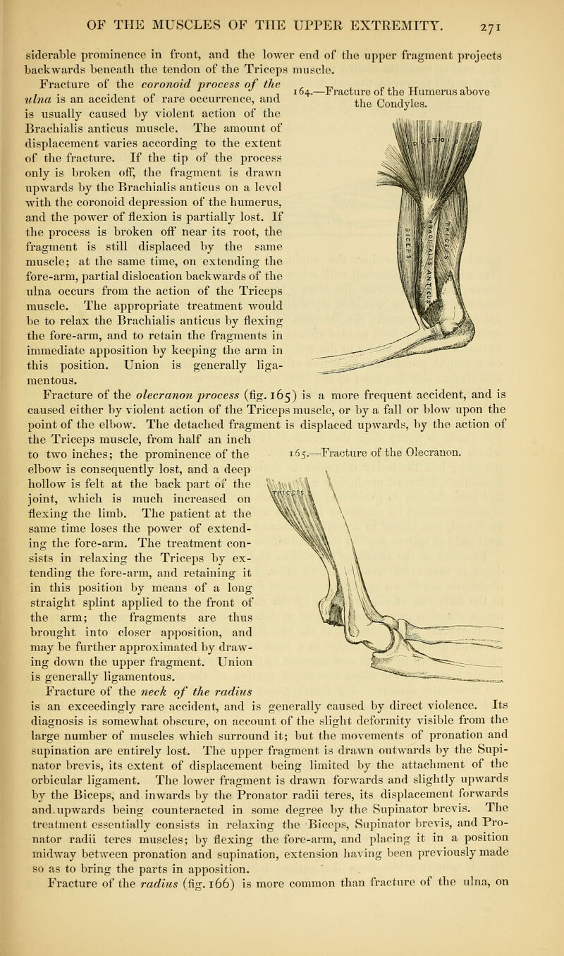 siderable prominence in fi'ont, and the lower end of the upper fragment projects backwards beneath the tendon of the Triceps muscle. Fracture of the coronoid process of the . t^ , o,-, tt ■, '■ '' \ 64.—Jj racture of the Humerus above the Condyles. \ ulna is an accident of rai-e occurrence, and is usually caused by violent action of the Brachialis anticus muscle. The amount of displacement varies according to the extent of the fracture. If the tip of the process only is broken off, the fragment is drawn upwards by the Brachialis anticus on a level with the coronoid depression of the humerus, and the power of flexion is partially lost. If the process is broken off near its root, the fragment is still displaced by the same muscle; at the same time, on extending the fore-arm, partial dislocation backwards of the ulna occurs from the action of the Triceps muscle. The appropriate treatment would be to relax the Brachialis anticus by flexing the fore-arm, and to retain the fragments in immediate apposition by keeping the arm in this position. Union is generally liga- mentous. Fracture of the olecranon process (fig. 165) is a more frequent accident, and is caused either by violent action of the Triceps muscle, or by a fall or blow upon the point of the elbow. The detached fragment is displaced upwards, by the action of the Triceps muscle, from half an inch to two inches; the prominence of the 165.—Fracture of the Olecranon. elbow is consequently lost, and a deep hollow is felt at the back part of the joint, which is much increased on flexing the limb. The patient at the same time loses the power of extend- ing the fore-arm. The treatment con- sists in relaxing the Triceps by ex- tending the fore-arm, and retaining it in this position by means of a long straight splint applied to the front of the arm; the fragments are thus brought into closer apposition, and may be further approximated by draw- ing down the upper fragment. Union is generally ligamentous. Fracture of the neck of the radius is an exceedingly rare accident, and is generally caused by direct violence. Its diagnosis is somewhat obscure, on account of the slight deformity visible from the large number of muscles which surround it; but the movements of pronation and supination are entirely lost. The upper fragment is drawn outwards by the Supi- nator brevis, its extent of displacement being limited by the attachment of the orbicular ligament. The lower fragment is drawn forwards and slightly upwards by the Biceps, and inwards by the Pronator radii teres, its displacement forwards and,upwards being counteracted in some degree by the Supinator brevis. The treatment essentially consists in relaxing the Biceps, Supinator brevis, and Pro- nator radii teres muscles; by flexing the fore-arm, and placing it in a position midway between pronation and supination, extension having been previously made so as to bring the parts in apposition. Fracture of the radius (fig. 166) is more common than fracture of the ulna, on