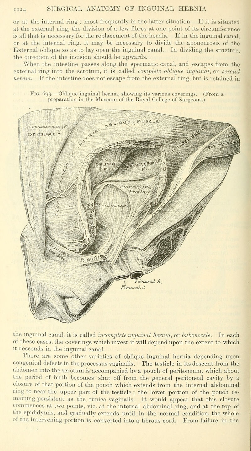 or at the internal ring ; most frequently in the latter situation. If it is situated at the external ring, the division of a few fibres at one point of its circumference is all that is necessary for the replacement of the hernia. If in the inguinal canal, or at the internal ring, it may be necessary to divide the aponeurosis of the External oblique so as to lay open the inguinal canal. In dividing the stricture, the direction of the incision should be upwards. When the intestine passes along the spermatic canal, and escapes from the external ring into the scrotum, it is called complete oblique inguinal, or scrotal hernia. If the intestine does not escape from the external ring, but is retained in Fig. 693.—-Oblique inguinal hernia, showing its various coverings. (From a preparation in the Museum of the Eoyal College of Surgeons.) .r txr oauque. v ' ^s^ 1.1 qc? - —^35395^3;:^:^-— , ^ I - - FemoraL '/. the inguinal canal, it is called incomplete inguinal hernia, or bubonocele. In each of these cases, the coverings which invest it will depend upon the extent to which it descends in the inguinal canal. Thei-e are some other varieties of oblique inguinal hernia depending upon congenital defects in the processus vaginalis. The testicle in its descent from the abdomen into the scrotum is accompanied by a pouch of peritoneum, which about the period of birth becomes shut off from the general peritoneal cavity by a closure of that portion of the pouch which extends from the internal abdominal ring to near the upper part of the testicle ; the lower portion of the pouch re- maining persistent as the, tunica vaginahs. It would appear that this closure commences at two points, viz. at the internal abdominal ring, and at the top of the epididymis, and gradually extends until, in the normal condition, the whole of the intervening portion is converted into a fibrous cord. From failure in the