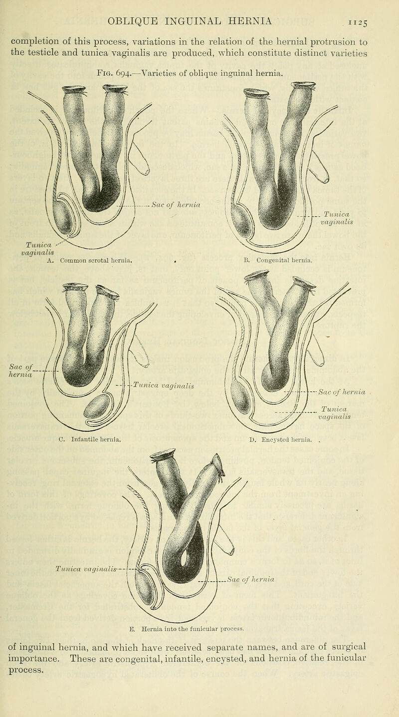 completion of this process, variations in the relation of the hernial protrusion to the testicle and tunica vaginalis are produced, which constitute distinct varieties Fig. 694.—Varieties of oblique inguinal hernia. Sao of_ herniaT Sac of hernia Tunica vaginalis Tunica vaginalis- )/ htJ-nia E. Hernia iuto the funicular process. of inguinal hernia, and v^^hich have received separate names, and are of surgical importance. These are congenital, infantile, encysted, and hernia of the funicular process.