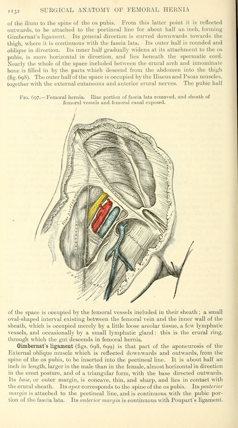 of the ilium to the spine of the os pubis. From this latter point it is reflected outwards, to be attached to the pectineal line for about half an inch, forming Gimbernat's ligament. Its general direction is curved downwards towards the thigh, where it is continuous with the fascia lata. Its outer half is rounded and oblique in direction. Its inner half gradually widens at its attachment to the os pubis, is more horizontal in direction, and lies beneath the spermatic cord. Nearly the whole of the space included betw^een the crural arch and innominate bone is filled in by the parts which descend from the abdomen into the thigh (fig. 698). The outer half of the space is occupied by the Ihacus and Psoas muscles, together with the external cutaneous and anterior crural nerves. The pubic half Fig. 697.—Femoral hernia. Iliac portion of fascia lata removed, and sheath of femoral vessels and femoral canal exposed. of the space is occupied by the femoral vessels included in their sheath; a small oval-shaped interval existing between the femoral vein and the inner wall of the sheath, which is occupied merely by a little loose areolar tissue, a few lymphatic vessels, and occasionally by a small lymphatic gland: this is the crural ring, through which the gut descends in femoral hernia. Gimbernat's ligament (figs. 698, 699) is that part of the aponeurosis of the External oblique muscle which is reflected downwards and outwards, from the spine of the os pubis, to be inserted into the pectineal line. It is about half an inch in length, larger in the male than in the female, almost horizontal in direction in the erect posture, and of a triangular form, with the base directed outwards. Its base, or outer margin, is concave, thin, and sharp, and lies in contact with the crural sheath. Its a2Jex corresponds to the spine of the os pubis, lis posterior margin is attached to the pectineal line, and is continuous with the pubic por- tion of the fascia lata. Its anterior margin is continuous with Poupart's ligament.