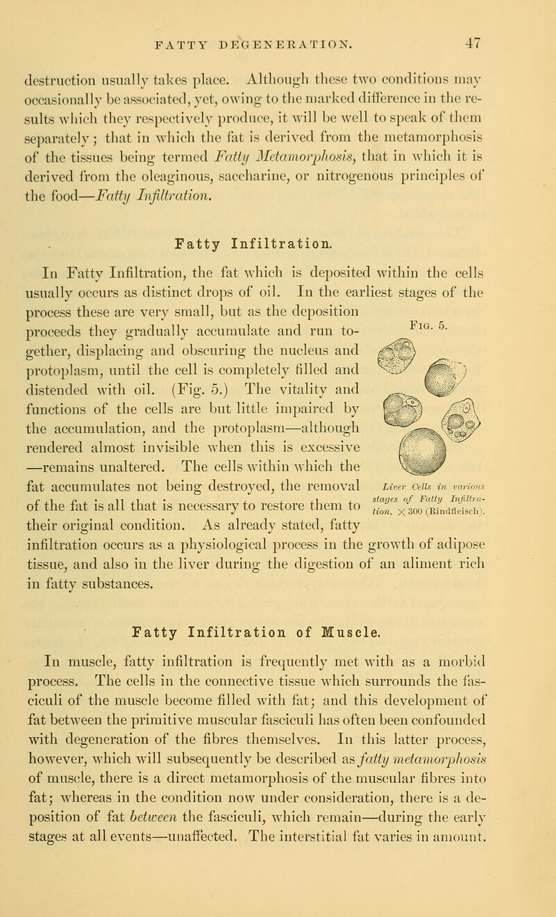 destruction usually takes place. Although these two conditions may occasionally be associated, yet, owing to the marked difference in the re- sults which they respectively produce, it will be well to speak of them separately; that in which the fat is derived from the metamorphosis of the tissues being termed Fatty Metamorphosis, that in which it is derived from the oleaginous, saccharine, or nitrogenous principles of the food—Fatty Infiltration. Fatty Infiltration. In Fatty Infiltration, the fat which is deposited within the cells usually occurs as distinct drops of oil. In the earliest stages of the process these are very small, but as the deposition proceeds they gradually accumulate and run to- ^^ gether, displacing and obscuring the nucleus and protoplasm, until the cell is completely filled and distended with oil. (Fig. 5.) The vitality and functions of the cells are but little impaired by the accumulation, and the protoplasm—although rendered almost invisible when this is excessive —remains unaltered. The cells within which the fat accumulates not being destroyed, the removal uver ceiu in vano?i>: of the fat is all that is necessary to restore them to Ton.'ximSn£isch). their original condition. As already stated, fatty infiltration occurs as a physiological process in the growth of adipose tissue, and also in the liver during the digestion of an aliment rich in fatty substances. Fatty Infiltration of Muscle. In muscle, fatty infiltration is frequently met with as a morbid process. The cells in the connective tissue which surrounds the fas- ciculi of the muscle become filled with fat; and this development of fat between the primitive muscular fasciculi has often been confounded with degeneration of the fibres themselves. In this latter process, however, which will subsequently be described ^.s, fatty metamorphosis of muscle, there is a direct metamorphosis of the muscular fibres into fat; whereas in the condition now under consideration, there is a de- position of fat between the fasciculi, which remain—during the early stages at all events—unaffected. The interstitial fat varies in amount.