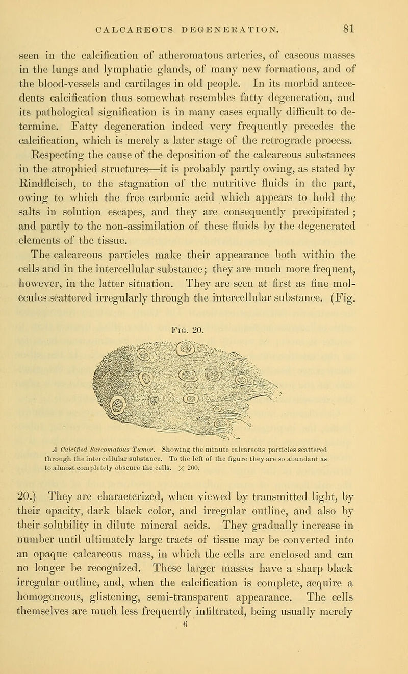 seen in the calcification of atlicroinatous arteries, of caseous masses in tlie lungs and lymphatic glands, of many new formations, and of the blood-vessels and cartilages in old people. In its morbid antece- dents calcification thus somewhat resembles fatty degeneration, and its pathological signification is in many cases equally difficult to de- termine. Fatty degeneration indeed very frequently precedes the calcification, which is merely a later stage of the retrograde process. Respecting the cause of the deposition -of the calcareous substances in the atrophied structures—it is probably partly owing, as stated by Rindfleisch, to the stagnation of the nutritive fluids in the part, owing to which the free carbonic acid which appears to hold the salts in solution escapes, and they are consequently precipitated ; and partly to the non-assimilation of these fluids by the degenerated elements of the tissue. The calcareous particles make their appearance both within the cells and in the intercellular substance; they are much more frequent, however, in the latter situation. They are seen at first as fine mol- ecules scattered irregularly through the intercellular substance. (Fig. Fig 20. A Calcified Sarcomatous Tumor. Showing the minute calcareous particles scattered through the intercellular substance. To the left of the figure they are so abundant as to almost completely obscure the cells. X 200. 20.) They are characterized, when viewed by transmitted light, by their opacity, dark black color, and irregular outline, and also by their solubility in dilute mineral acids. They gradually increase in number until ultimately large tracts of tissue may be converted into an opaque calcareous mass, in which the cells are enclosed and can no longer be recognized. These larger masses have a sharp black irregular outline, and, when the calcification is complete, stcquire a homogeneous, glistening, semi-transparent appearance. The cells themselves are much less frequently infiltrated, being usually merely 6