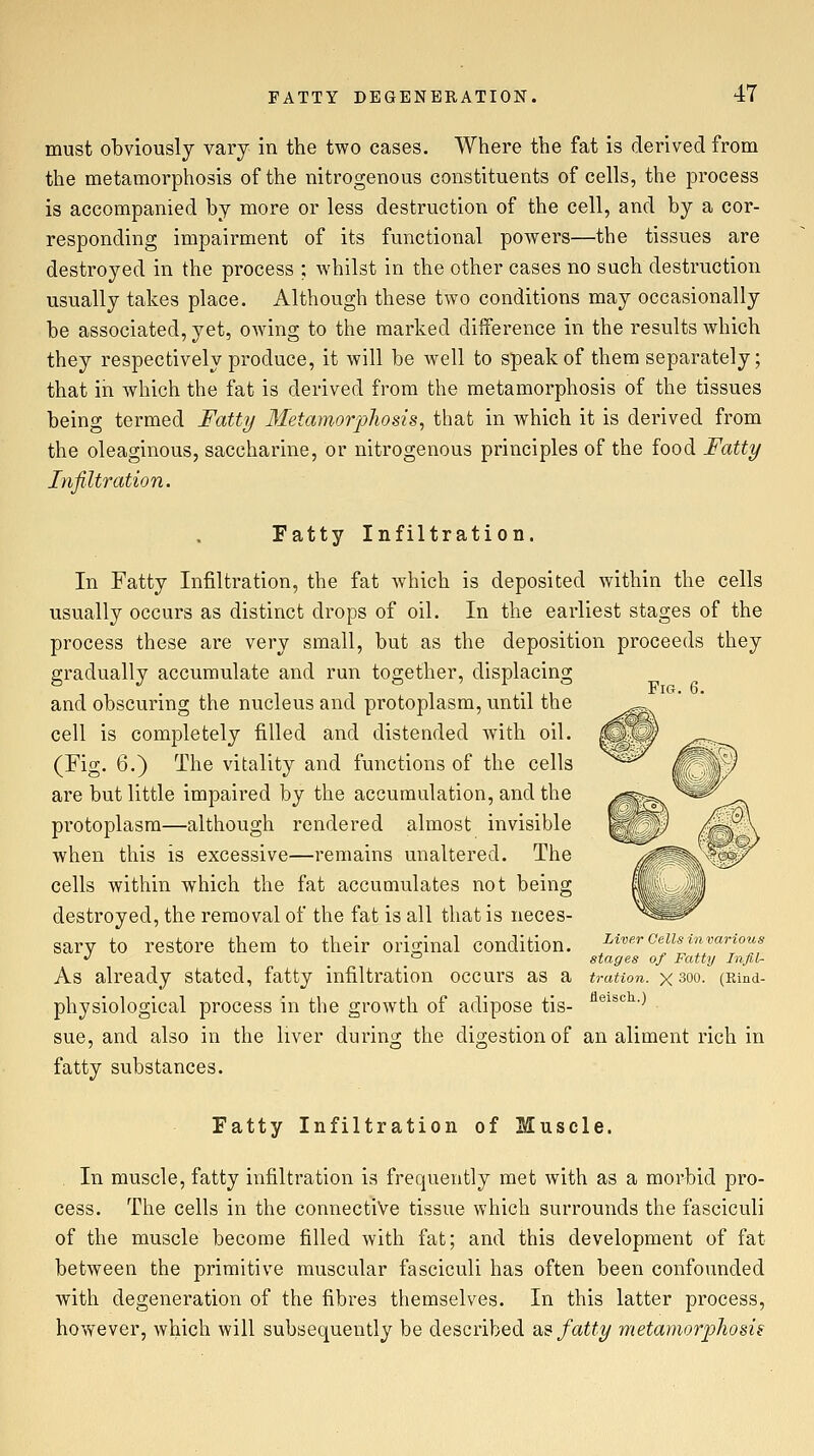 must obviously vary in the two cases. Where the fat is derived from the metamorphosis of the nitrogenous constituents of cells, the process is accompanied by more or less destruction of the cell, and by a cor- responding impairment of its functional powers—the tissues are destroyed in the process ; whilst in the other cases no such destruction usually takes place. Although these two conditions may occasionally be associated, yet, owing to the marked difference in the results which they respectively produce, it will be well to speak of them separately; that in which the fat is derived from the metamorphosis of the tissues being termed Fatty Metamorphosis, that in which it is derived from the oleaginous, saccharine, or nitrogenous principles of the food Fatty Infiltration. Fatty Infiltration. In Fatty Infiltration, the fat Avhich is deposited within the cells usually occurs as distinct drops of oil. In the earliest stages of the process these are very small, but as the deposition proceeds they gradually accumulate and run together, displacing and obscuring the nucleus and protoplasm, until the cell is completely filled and distended with oil. (Fig. 6.) The vitality and functions of the cells are but little impaired by the accumulation, and the protoplasm—although rendered almost invisible when this is excessive—remains unaltered. The cells within which the fat accumulates not being destroyed, the removal of the fat is all that is neces- sary to restore them to their original condition. As already stated, fatty infiltration occurs as a tratton. x 3oo. (Emd- physiological process in the growth of adipose tis- ^^^^'^^■^ sue, and also in the liver during the digestion of an aliment rich in fatty substances. Fig. 6. Liver Cells- in various stages of Fatty InfiU Fatty Infiltration of Muscle. . In muscle, fatty infiltration is frequently met with as a morbid pro- cess. The cells in the connective tissue which surrounds the fasciculi of the muscle become filled with fat; and this development of fat between the primitive muscular fasciculi has often been confounded with degeneration of the fibres themselves. In this latter process, however, which will subsequently be described 2,^ fatty metamorpJiosis