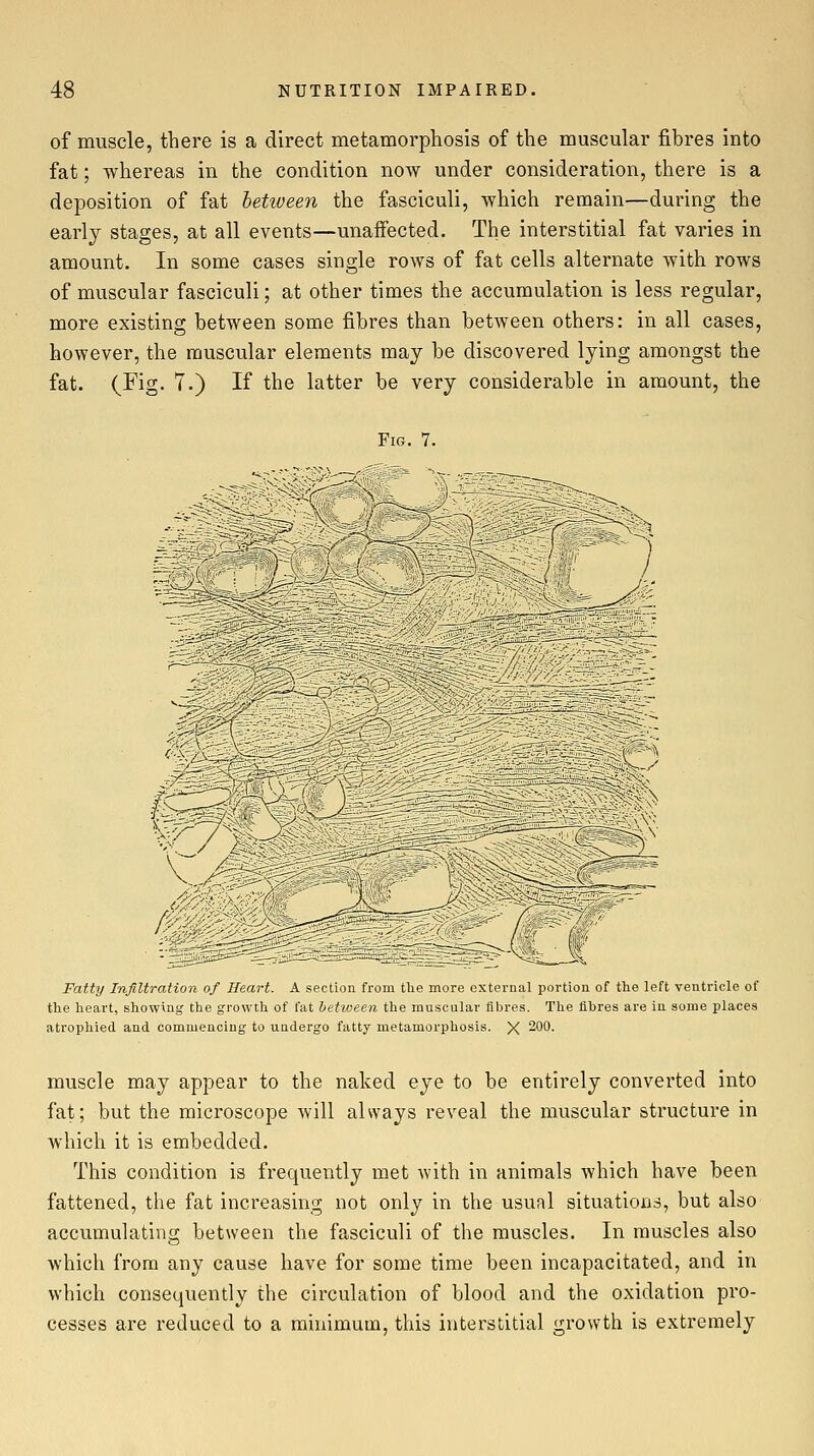 of muscle, there is a direct metamorpliosis of the muscular fihres into fat; whereas in the condition now under consideration, there is a deposition of fat betiveen the fasciculi, which remain—during the earlj stages, at all events—unaffected. The interstitial fat varies in amount. In some cases single rows of fat cells alternate with rows of muscular fasciculi; at other times the accumulation is less regular, more existing between some fibres than between others: in all cases, however, the muscular elements may be discovered lying amongst the fat. (Fig- 7.) If the latter be very considerable in amount, the Fig. 7. 'siCM^. Fatty Infiltration of Heart. A section from the more external portion of the left ventricle of the heart, showing the growth of fat between the muscular fibres. The fibres are in some places atrophied and commencing to undergo fattj metamorphosis. X 200. muscle may appear to the naked eye to be entirely converted into fat; but the microscope will always reveal the muscular structure in which it is embedded. This condition is frequently met with in animals which have been fattened, the fat increasing not only in the usual situations, but also accumulating between the fasciculi of the muscles. In muscles also which from any cause have for some time been incapacitated, and in which consequently the circulation of blood and the oxidation pro- cesses are reduced to a minimum, this interstitial growth is extremely