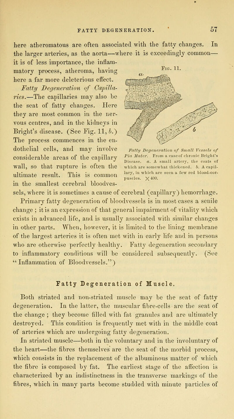 Fig. 11. here atheromatous are often associated with the fatty changes. In the larger arteries, as the aorta—where it is exceedingly common— it is of less importance, the inflam- matory process, atheroma, having here a far more deleterious effect. Fatty Degeneration of Capilla- ries.—The capillaries may also he the seat of fatty changes. Here they are most common in the ner- vous centres, and in the kidneys in Bright's disease. (See Fig. 11, 5.) The process commences in the en- dothelial cells, and may involve considerahle areas of the capillary wall, so that rupture is often the ultimate result. This is common in the smallest cerebral bloodves- sels, where it is sometimes a cause of cerebral (capillary) hemorrhage. Primary fatty degeneration of bloodvessels is in most cases a senile change ; it is an expression of that general impairment of vitality which exists in advanced life, and is usually associated Avith similar changes in other parts. When, however, it is limited to the lining membrane of the largest arteries it is often met with in early life and in persons who are otherwise perfectly healthy. Fatty degeneration secondary to inflammatory conditions Avill be considered subsequently. (See Inflammation of Bloodvessels.) Fatty Degeneration of Small Vessels of Pia Mater. From a case of chronic Bright's Disease, a. A small artery, the coats of which are somewhat thickened, b. A capil- lary, in which are seen a few red blood-cor- puscles. X tOO- Fatty Degeneration of Muscle. Both striated and non-striated muscle may be the seat of fatty degeneration. In the latter, the muscular fibre-cells are the seat of the change ; they become filled with fat granules and are ultimately destroyed. This condition is frequently met with in the middle coat of arteries which are undergoing fatty degeneration. In striated muscle—both in the voluntary and in the involuntary of the heart—the fibres themselves are the seat of the morbid process, which consists in the replacement of the albuminous matter of which the fibre is composed by fat. The earliest stage of the affection is characterized by an indistinctness in the transverse markings of the fibres, which in many parts become studded with minute particles of