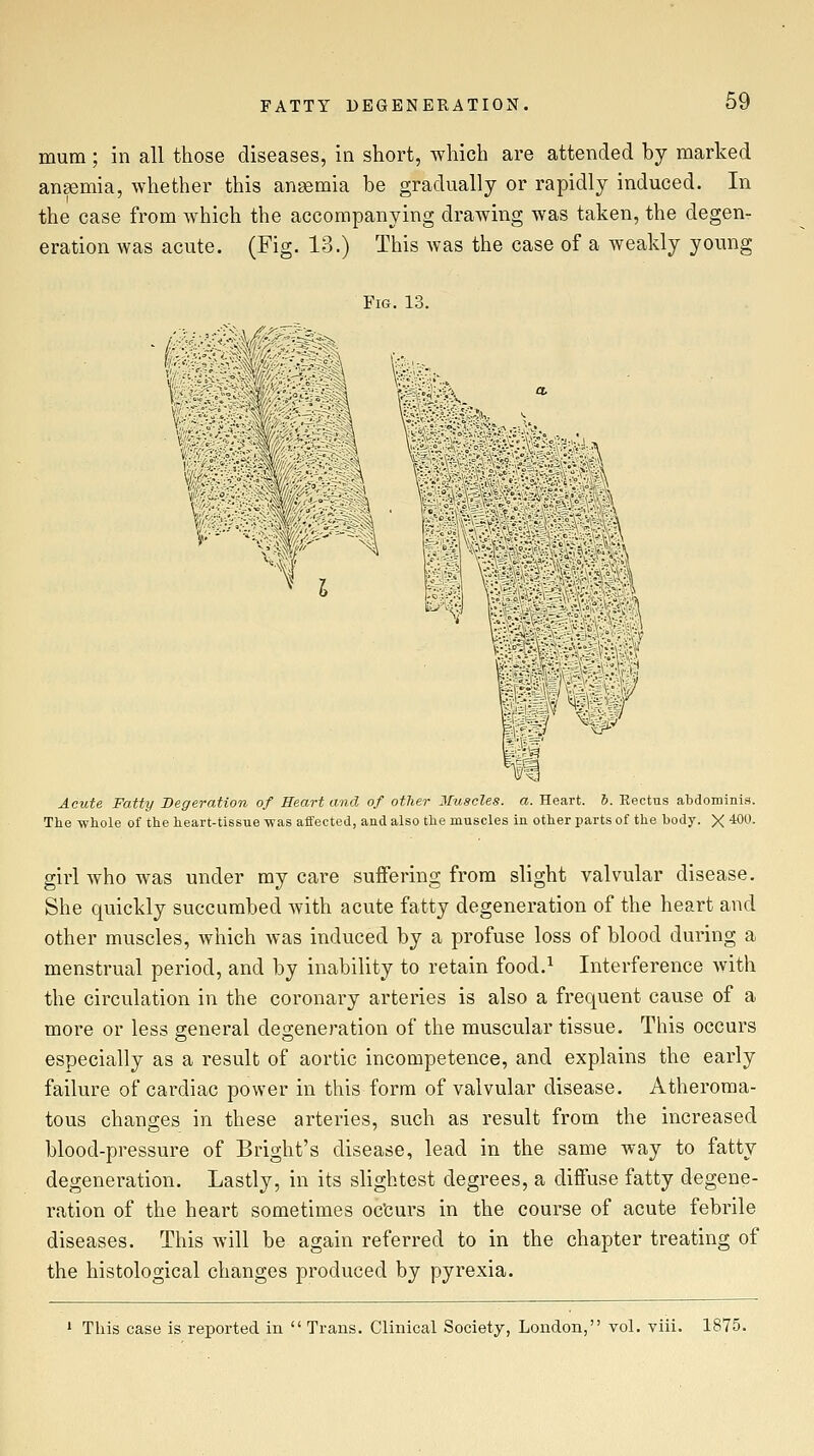 mum ; in all those diseases, in short, which are attended by marked angemia, whether this angemia be gradually or rapidly induced. In the case from which the accompanying drawing was taken, the degen- eration was acute. (Fig. 13.) This was the case of a weakly young Fig. 13. « i WW Acute Fatty Begeration of Heart and of other 2ruacles. a. Heart. 6. Eectus abdominis. The whole of the heart-tissue was affected, and also the muscles in other parts of the body. X '^00. girl who was under my care suffering from slight valvular disease. She quickly succumbed Avith acute fatty degeneration of the heart and other muscles, which was induced by a profuse loss of blood during a menstrual period, and by inability to retain food.^ Interference with the circulation in the coronary arteries is also a frequent cause of a more or less general degeneration of the muscular tissue. This occurs especially as a result of aortic incompetence, and explains the early failure of cardiac power in this form of valvular disease. Atheroma- tous changes in these arteries, such as result from the increased blood-pressure of Bright's disease, lead in the same way to fatty degeneration. Lastly, in its slightest degrees, a diffuse fatty degene- ration of the heart sometimes oc'curs in the course of acute febrile diseases. This will be again referred to in the chapter treating of the histological changes produced by pyrexia. ' This case is reported in  Trans. Clinical Society, London, vol. viii. 1875.
