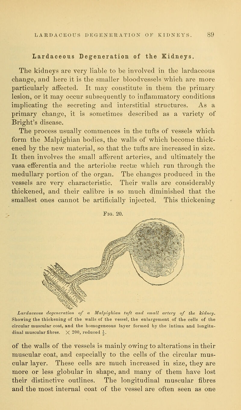 Lardaceous Degeneration of the Kidneys. The kidneys are very liable to be involved in the lardaceous change, and here it is the smaller bloodvessels which are more particularly affected. It may constitute in them the primary lesion, or it may occur subsequently to inflammatory conditions implicating the secreting and interstitial structures. As a primary change, it is sometimes described as a variety of Bright's disease. The process usually commences in the tufts of vessels which form the Malpighian bodies, the walls of which become thick- ened by the new material, so that the tufts are increased in size. It then involves the small afferent arteries, and ultimately the vasa efferentia and the arterioles rectse which run through the medullary portion of the organ. The changes produced in the vessels are very characteristic. Their walls are considerably thickened, and their calibre is so much diminished that the smallest ones cannot be artificially injected. This thickening Fig. 20. Lardaceous degeneration of a Malpigfiian tuft and small artery of the hidney. Showing the thickening of the walls of the vessel, the enlargement of the cells of the circular muscular coat, and the homogeneous layer formed by the intima and longitu- dinal muscular fibres. X 200, reduced 1. of the walls of the vessels is mainly owing to alterations in their muscular coat, and especially to the cells of the circular mus- cular layer. These cells are much increased in size, they are more or less globular in shape, and many of them have lost their distinctive outlines. The longitudinal muscular fibres and the most internal coat of the vessel are often seen as one