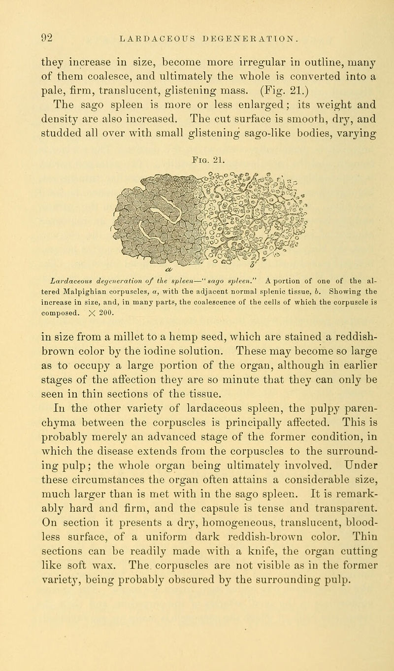 they increase in size, become more irregular in outline, many of them coalesce, and ultimately the whole is converted into a pale, firm, translucent, glistening mass. (Fig. 21.) The sago spleen is more or less enlarged; its weight and density are also increased. The cut surface is smooth, dry, and studded all over with small glistening sago-like bodies, varying Fig. 21. a/ Lardaceous degeneration of tlie spleen—sago spleen. A portion of one of the al- tered Malpighian corpuscles, a, with the adjacent normal splenic tissue, b. Showing the increase in size, and, in many parts, the coalescence of the cells of which the corpuscle is composed. X 200. in size from a millet to a hemp seed, which are stained a reddish- brown color by the iodine solution. These may become so large as to occupy a large portion of the organ, although in earlier stages of the affection they are so minute that they can only be seen in thin sections of the tissue. In the other variety of lardaceous spleen, the pulpy paren- chyma between the corpuscles is principally affected. This is probably merely an advanced stage of the former condition, in which the disease extends from the corpuscles to the surround- ing pulp; the whole organ being ultimately involved. Under these circumstances the organ often attains a considerable size, much larger than is met with in the sago spleen. It is remark- ably hard and firm, and the capsule is tense and transparent. On section it presents a dry, homogeneous, translucent, blood- less surface, of a uniform dark reddish-brown color. Thin sections can be readily made with a knife, the organ cutting like soft wax. The. corpuscles are not visible as iu the former variety, being probably obscured by the surrounding pulp.