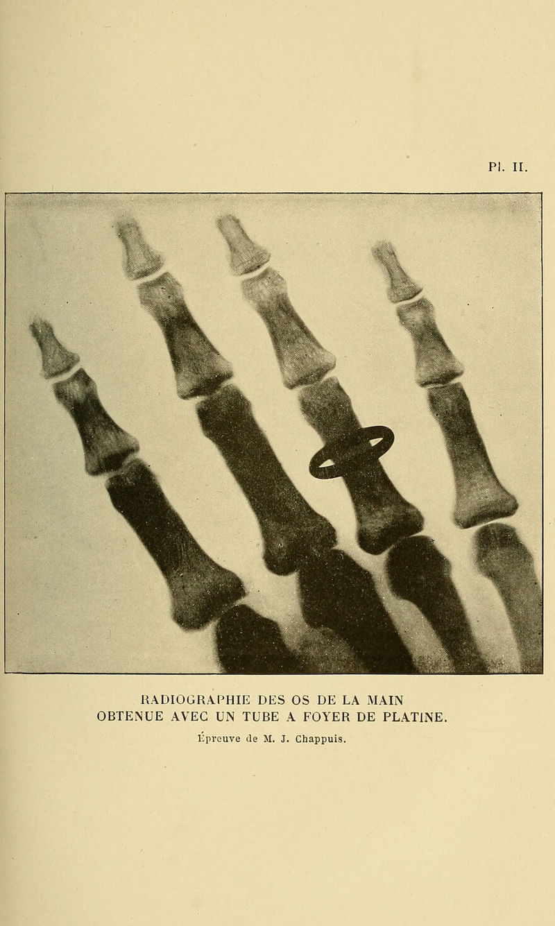 RADIOGRA.PHIE DES OS DE LA MAIN OBTENUE AVEC UN TUBE A FOYER DE PLATINE. Eprouve de M. J. Chappuis.