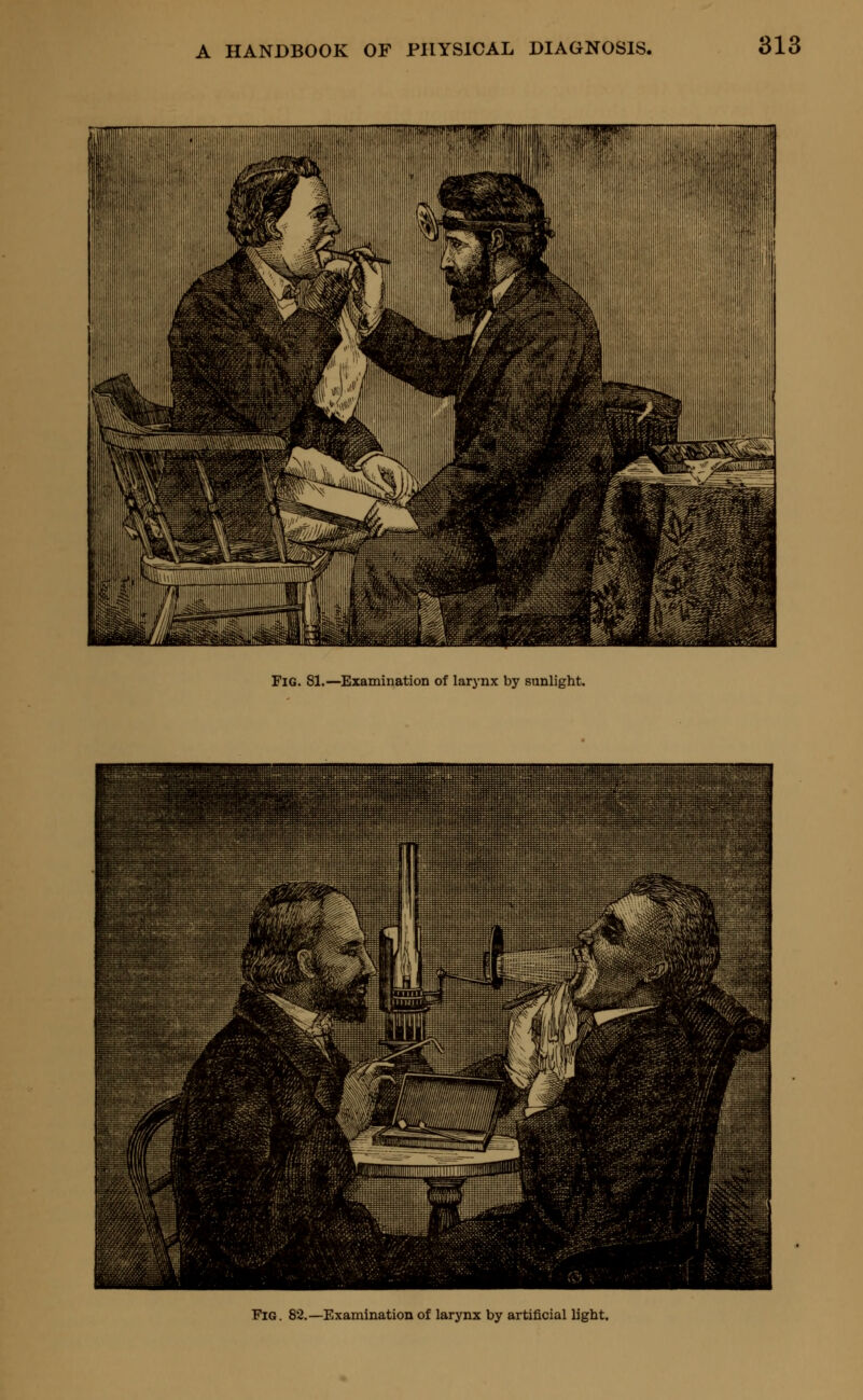 Fig. 81.—Examination of larynx by sunlight. Fig. 82.—Examination of larynx by artificial Ught.