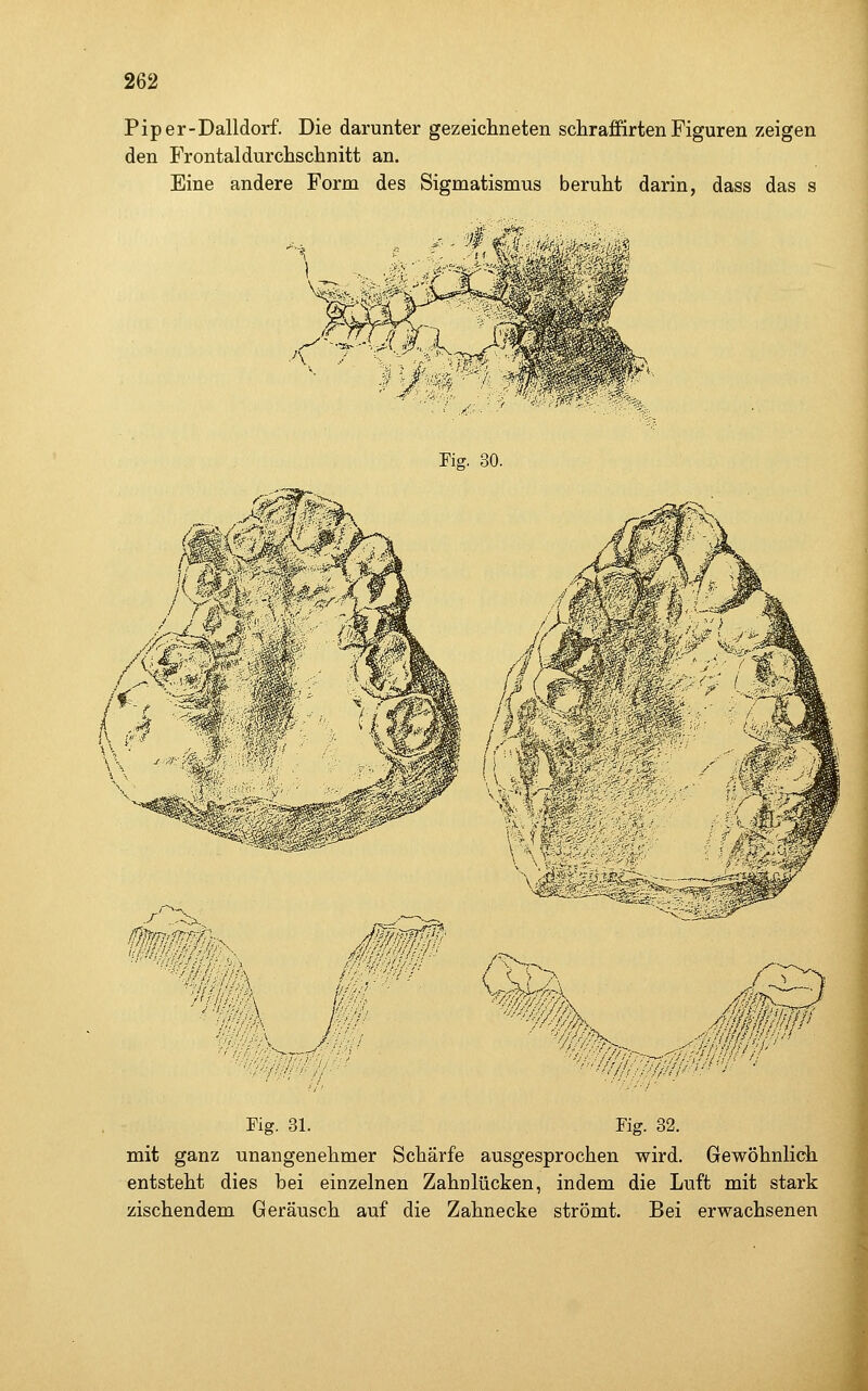 Piper-Dalldorf. Die darunter gezeichneten schraffirten Figuren zeigen den Frontaldurchschnitt an. Eine andere Form des Sigmatismus beruht darin, dass das s Fig. 30. 111 '<' t'tili'!'•'' :i' Fig. 31. Fig. 32. mit ganz unangenehmer Schärfe ausgesprochen wird. Gewöhnlich entsteht dies bei einzelnen Zahnlücken, indem die Luft mit stark zischendem Geräusch auf die Zahnecke strömt. Bei erwachsenen