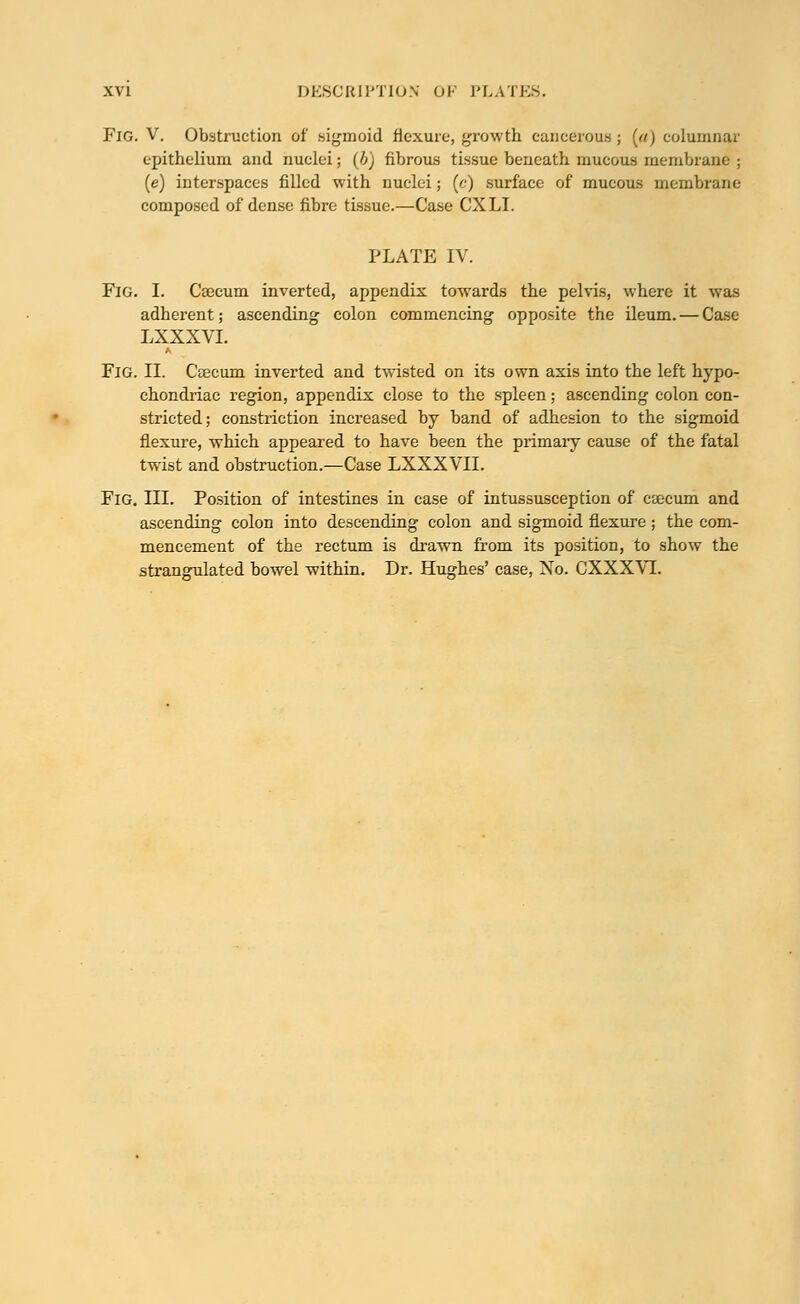 Fig. V. Obstruction of sigmoid flexure, growth cancerous ; («) columnar epithelium and nuclei; (b) fibrous tissue beneath mucous membrane ; (e) interspaces filled with nuclei; (c) surface of mucous membrane composed of dense fibre tissue.—Case CXLI. PLATE IV. Fig. I. Cajcum inverted, appendix towards the pelvis, where it was adherent; ascending colon commencing opposite the ileum. — Case LXXXVL Fig. II. Caecum inverted and twisted on its own axis into the left hypo- chondriac region, appendix close to the spleen; ascending colon con- stricted; constriction increased by band of adhesion to the sigmoid flexure, which appeared to have been the primary cause of the fatal twist and obstruction.—Case LXXXVII. Fig. III. Position of intestines in case of intussusception of cajcum and ascending colon into descending colon and sigmoid flexure ; the com- mencement of the rectum is drawn from its position, to show the strangulated bowel within. Dr. Hughes' case, No. CXXXVI.