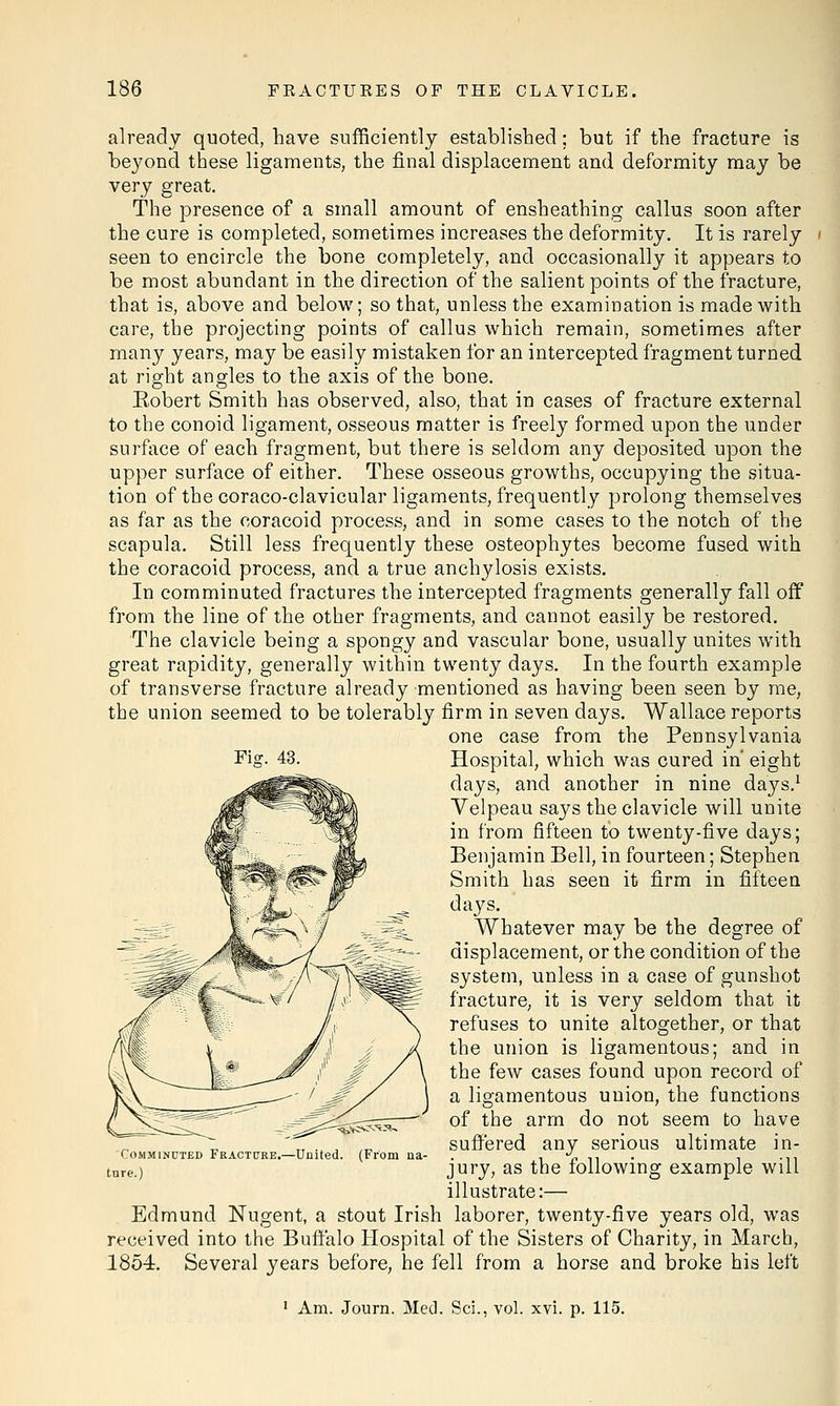 already quoted, have sufficiently established; but if the fracture is beyond these ligaments, the final displacement and deformity may be very great. The presence of a small amount of ensheathing callus soon after the cure is completed, sometimes increases the deformity. It is rarely seen to encircle the bone completely, and occasionally it appears to be most abundant in the direction of the salient points of the fracture, that is, above and below; so that, unless the examination is made with care, the projecting points of callus which remain, sometimes after many years, may be easily mistaken for an intercepted fragment turned at right angles to the axis of the bone. Eobert Smith has observed, also, that in cases of fracture external to the conoid ligament, osseous matter is freely formed upon the under surface of each fragment, but there is seldom any deposited upon the upper surface of either. These osseous growths, occupying the situa- tion of the coraco-clavicular ligaments, frequently prolong themselves as far as the coracoid process, and in some cases to the notch of the scapula. Still less frequently these osteophytes become fused with the coracoid process, and a true anchylosis exists. In comminuted fractures the intercepted fragments generally fall off from the line of the other fragments, and cannot easily be restored. The clavicle being a spongy and vascular bone, usually unites with great rapidity, generally within twenty days. In the fourth example of transverse fracture already mentioned as having been seen by me, the union seemed to be tolerably firm in seven days. Wallace reports one case from the Pennsylvania Hospital, which was cured in' eight days, and another in nine days.1 Velpeau says the clavicle will unite in from fifteen to twenty-five days; Benjamin Bell, in fourteen; Stephen Smith has seen it firm in fifteen days. Whatever may be the degree of displacement, or the condition of the system, unless in a case of gunshot fracture, it is very seldom that it refuses to unite altogether, or that the union is ligamentous; and in the few cases found upon record of a ligamentous union, the functions of the arm do not seem to have suffered any serious ultimate in- jury, as the following example will illustrate:— Edmund Nugent, a stout Irish laborer, twenty-five years old, was received into the Buffalo Hospital of the Sisters of Charity, in March, 1854. Several years before, he fell from a horse and broke his left Fiar. 43. Comminuted Fracture ture.) -United. (From na- 1 Am. Journ. Med. ScL, vol. xvi. p. 115.