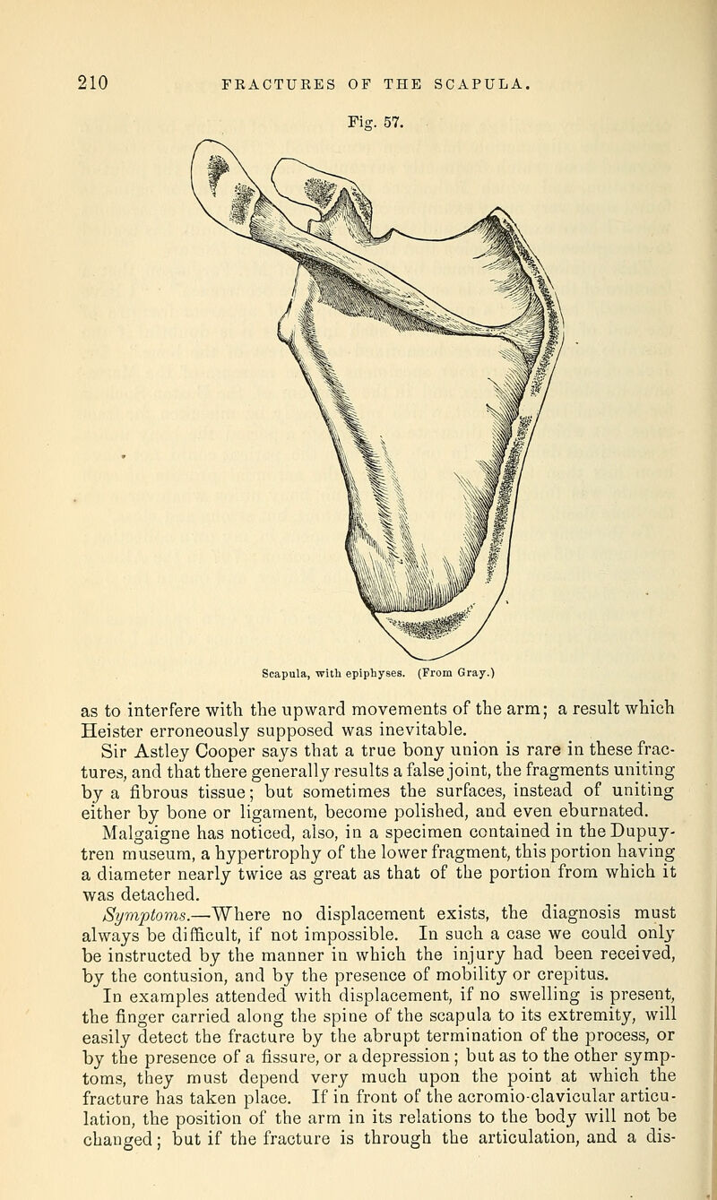 Fis. 57. Scapula, with epiphyses. (From Gray.) as to interfere with the upward movements of the arm; a result which Heister erroneously supposed was inevitable. Sir Astley Cooper says that a true bony union is rare in these frac- tures, and that there generally results a false joint, the fragments uniting by a fibrous tissue; but sometimes the surfaces, instead of uniting either by bone or ligament, become polished, and even eburnated. Malgaigne has noticed, also, in a specimen contained in theDupuy- tren museum, a hypertrophy of the lower fragment, this portion having a diameter nearly twice as great as that of the portion from which it was detached. Symptoms.—Where no displacement exists, the diagnosis must always be difficult, if not impossible. In such a case we could only be instructed by the manner in which the injury had been received, by the contusion, and by the presence of mobility or crepitus. In examples attended with displacement, if no swelling is present, the finger carried along the spine of the scapula to its extremity, will easily detect the fracture by the abrupt termination of the process, or by the presence of a fissure, or a depression ; but as to the other symp- toms, they must depend very much upon the point at which the fracture has taken place. If in front of the acromio-clavicular articu- lation, the position of the arm in its relations to the body will not be changed; but if the fracture is through the articulation, and a dis-