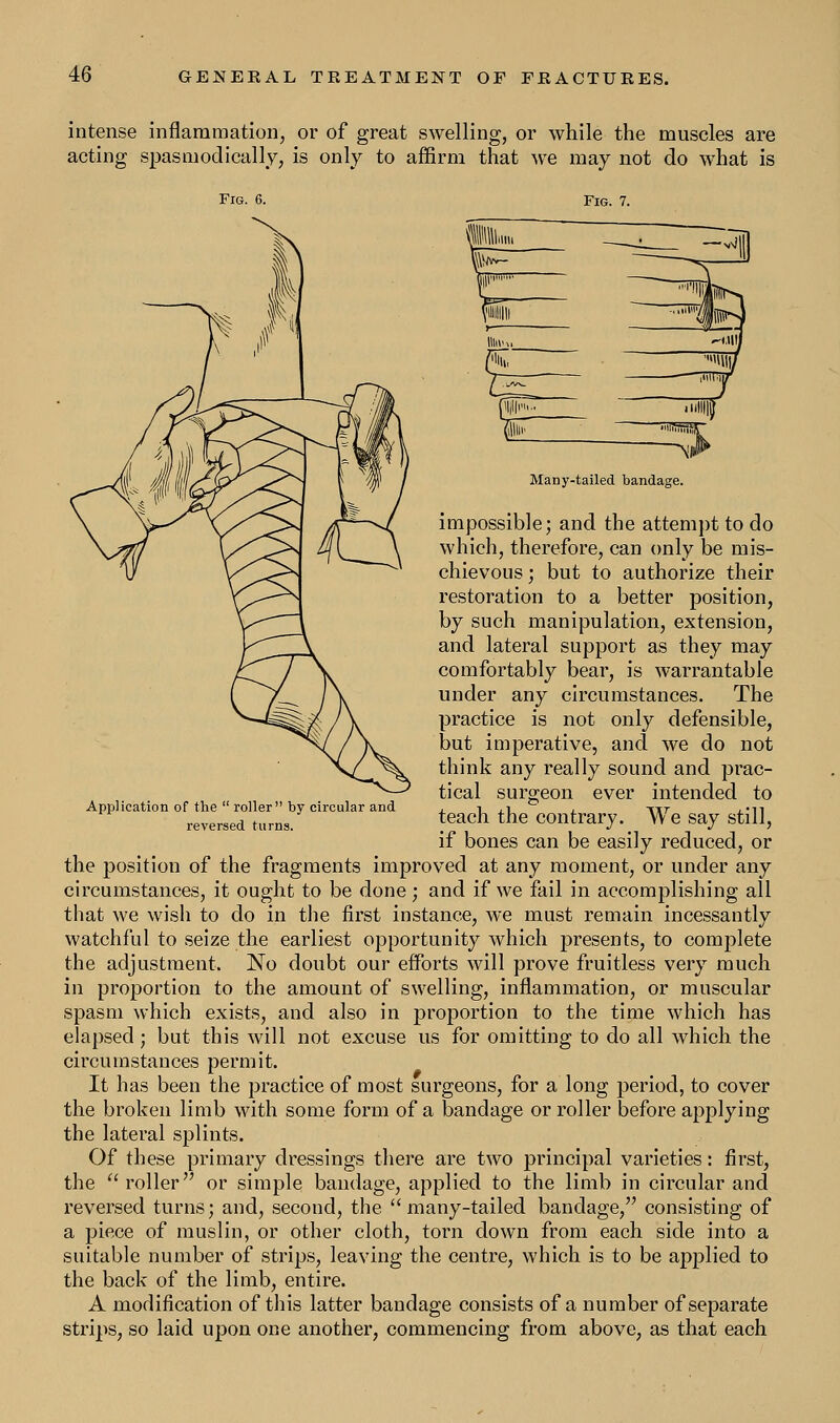 intense inflammation, or of great swelling, or while the muscles are acting spasmodically, is only to affirm that we may not do what is Fig. 6. Fig. 7. Application of the  roller by circular and. reversed turns. Many-tailed bandage. impossible; and the attempt to do which, therefore, can only be mis- chievous ; but to authorize their restoration to a better position, by such manipulation, extension, and lateral support as they may comfortably bear, is warrantable under any circumstances. The practice is not only defensible, but imperative, and we do not think any really sound and prac- tical surgeon ever intended to teach the contrary. We say still, if bones can be easily reduced, or the position of the fragments improved at any moment, or under any circumstances, it ought to be done; and if we fail in accomplishing all that we wish to do in the first instance, we must remain incessantly watchful to seize the earliest opportunity which presents, to complete the adjustment. No doubt our efforts will prove fruitless very much in proportion to the amount of swelling, inflammation, or muscular spasm which exists, and also in proportion to the time which has elapsed; but this will not excuse us for omitting to do all which the circumstances permit. It has been the practice of most surgeons, for a long period, to cover the broken limb with some form of a bandage or roller before applying the lateral splints. Of these primary dressings there are two principal varieties: first, the roller or simple bandage, applied to the limb in circular and reversed turns; and, second, the  many-tailed bandage, consisting of a piece of muslin, or other cloth, torn down from each side into a suitable number of strips, leaving the centre, which is to be applied to the back of the limb, entire. A modification of this latter bandage consists of a number of separate strips, so laid upon one another, commencing from above, as that each