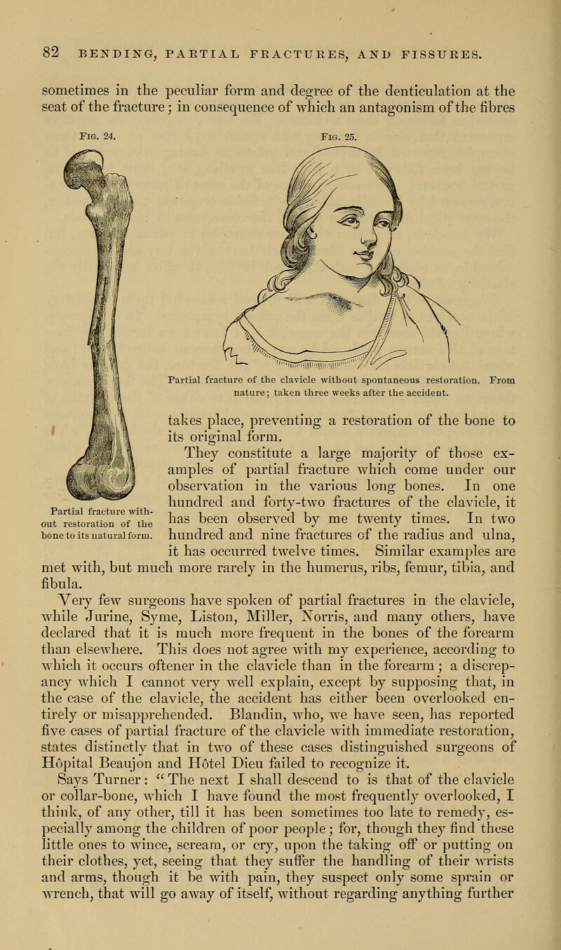 sometimes in the peculiar form and degree of the denticulation at the seat of the fracture; in consequence of which an antagonism of the fibres Fig. 24. Fig. 25. Partial fracture with- out restoration of the bone to its natural form. Partial fracture of the clavicle without spontaneous restoration. From nature; taken three weeks after the accident. takes place, preventing a restoration of the bone to its original form. They constitute a large majority of those ex- amples of partial fracture which come under our observation in the various long bones. In one hundred and forty-two fractures of the clavicle, it has been observed by me twenty times. In two hundred and nine fractures of the radius and ulna, it has occurred twelve times. Similar examples are met with, but much more rarely in the humerus, ribs, femur, tibia, and fibula. Very few surgeons have spoken of partial fractures in the clavicle, while Jurine, Syme, Liston, Miller, JMorris, and many others, have declared that it is much more frequent in the bones of the forearm than elsewhere. This does not agree with my experience, according to which it occurs oftener in the clavicle than in the forearm; a discrep- ancy which I cannot very well explain, except by supposing that, in the case of the clavicle, the accident has either been overlooked en- tirely or misapprehended. Blandin, who, we have seen, has reported five cases of partial fracture of the clavicle with immediate restoration, states distinctly that in two of these cases distinguished surgeons of Hopital Beaujon and Hotel Dieu failed to recognize it. Says Turner:  The next I shall descend to is that of the clavicle or collar-bone, which I have found the most frequently overlooked, I think, of any other, till it has been sometimes too late to remedy, es- pecially among the children of poor people; for, though they find these little ones to wince, scream, or cry, upon the taking off or putting on their clothes, yet, seeing that they suffer the handling of their wrists and arms, though it be with pain, they suspect only some sprain or wrench, that will go away of itself, without regarding anything further