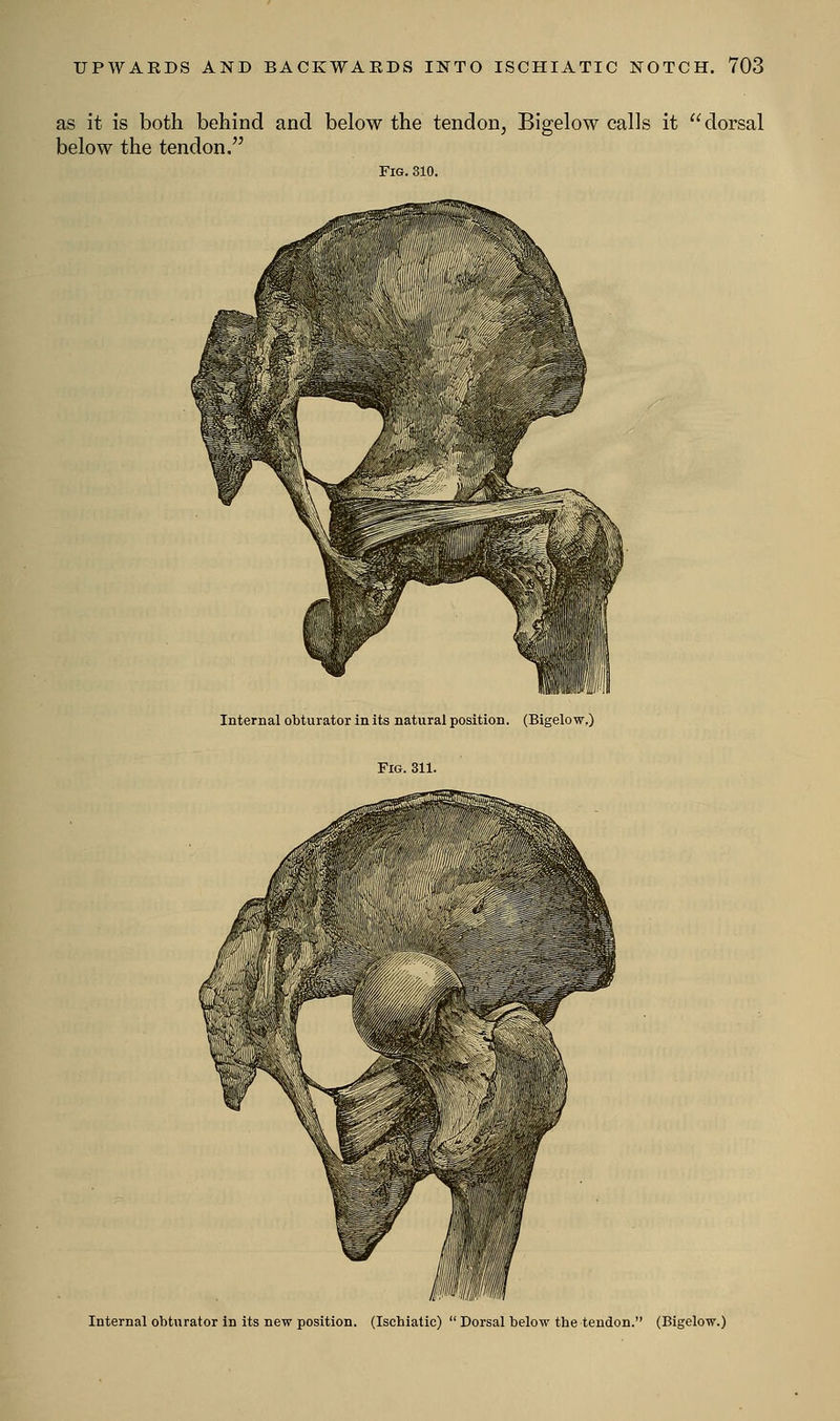 as it is both behind and below the tendon, Bigelow calls it dorsal below the tendon. Fig. 310. •10'' ; '■'■■'!''.' .„'■,■.'',;;'■',./' It Internal obturator in its natural position. (Bigelow.) \:'■-^i■/^^•.;'.:'';;■:=iV^w^:■: :--« Internal obturator in its new position. (Ischiatic)  Dorsal below tbe tendon. (Bigelow.)