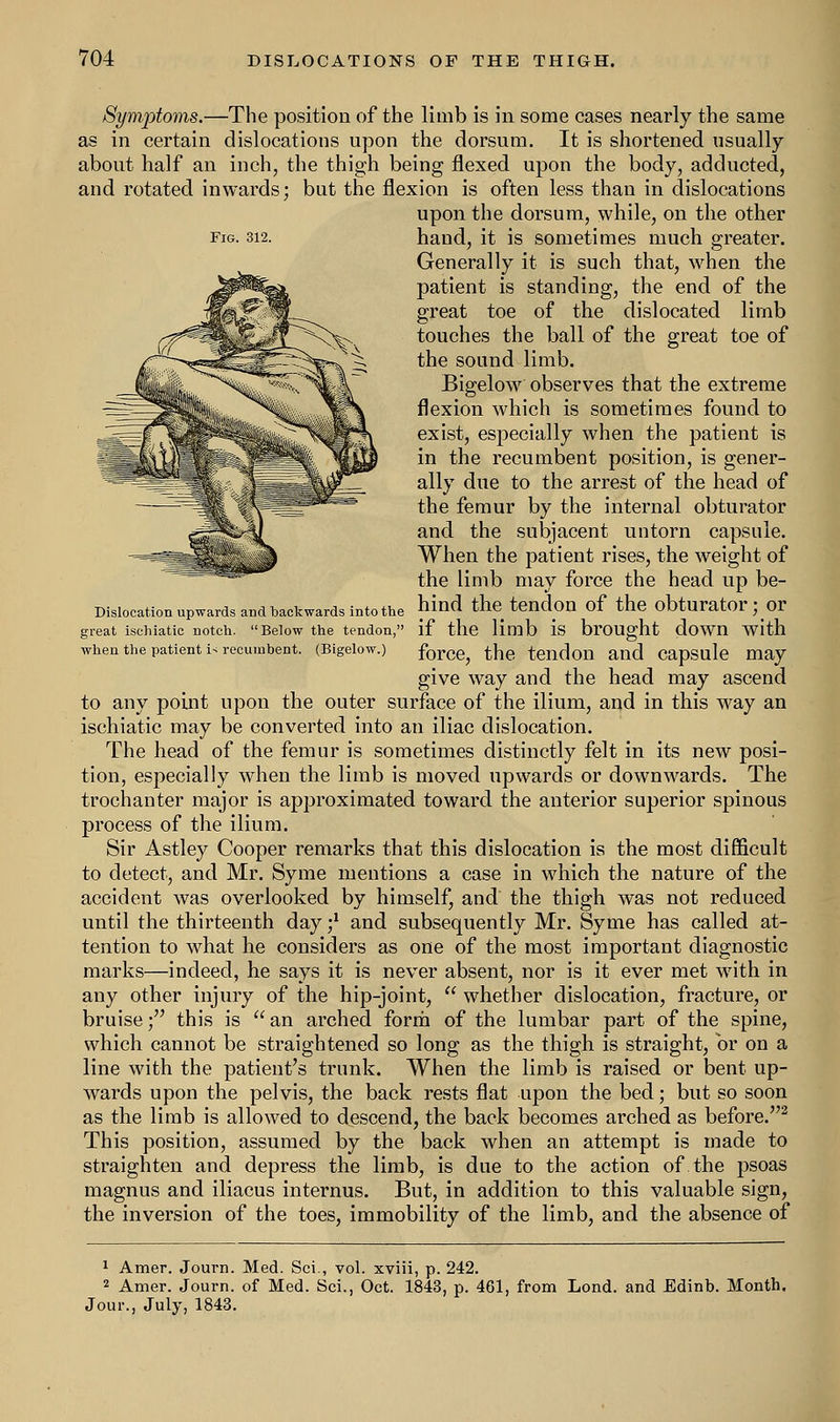 Dislocation upwards and backwards into the great ischiatic notch. Below the tendon, when the patient i< recumbent. (Bigelow.) Symptoms.—The position of the limb is in some cases nearly the same as in certain dislocations upon the dorsum. It is shortened usually about half an inch, the thigh being flexed upon the body, adducted, and rotated inwards; but the flexion is often less than in dislocations upon the dorsum, while, on the other Fig. 312. hand, it is sometimes much greater. Generally it is such that, when the patient is standing, the end of the great toe of the dislocated limb touches the ball of the great toe of the sound limb. Bigelow observes that the extreme flexion which is sometimes found to exist, especially when the patient is in the recumbent position, is gener- ally due to the arrest of the head of the femur by the internal obturator and the subjacent untorn capsule. When the patient rises, the weight of the limb may force the head up be- hind the tendon of the obturator; or if the limb is brought down with force, the tendon and capsule may give way and the head may ascend to any point upon the outer surface of the ilium, and in this way an ischiatic may be converted into an iliac dislocation. The head of the femur is sometimes distinctly felt in its new posi- tion, especially when the limb is moved upwards or downwards. The trochanter major is approximated toward the anterior superior spinous process of the ilium. Sir Astley Cooper remarks that this dislocation is the most difficult to detect, and Mr. Syme mentions a case in which the nature of the accident was overlooked by himself, and the thigh was not reduced until the thirteenth day ;* and subsequently Mr. Syme has called at- tention to what he considers as one of the most important diagnostic marks—indeed, he says it is never absent, nor is it ever met with in any other injury of the hip-joint,  whether dislocation, fracture, or bruise; this is  an arched form of the lumbar part of the spine, which cannot be straightened so long as the thigh is straight, or on a line with the patient's trunk. When the limb is raised or bent up- wards upon the pelvis, the back rests flat upon the bed; but so soon as the limb is allowed to descend, the back becomes arched as before.2 This position, assumed by the back when an attempt is made to straighten and depress the limb, is due to the action of the psoas magnus and iliacus internus. But, in addition to this valuable sign, the inversion of the toes, immobility of the limb, and the absence of 1 Araer. Journ. Med. Sci., vol. xviii, p. 242. 2 Amer. Journ. of Med. Sci., Oct. 1843, p. 461, from Lond. and Edinb. Month. Jour., July, 1843.