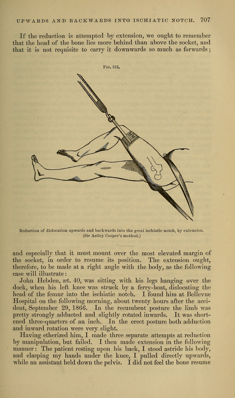 If the reduction is attempted by extension, we ought to remember that the head of the bone lies more behind than above the socket, and that it is not requisite to carry it downwards so much as forwards; Keduction of dislocation upwards and backwards into the great ischiatic notch, by extension. (Sir Astley Cooper's method.) and especially that it must mount over the most elevated margin of the socket, in order to resume its. position. The extension ought, therefore, to be made at a right angle with the body, as the following case will illustrate: John Hebden, set. 40, was sitting with his legs hanging over the dock, when his left knee was struck by a ferry-boat, dislocating the head of the femur into the ischiatic notch. I found him at Bellevue Hospital on the following morning, about twenty hours after the acci- dent, September 29, 1866. In the recumbent posture the limb was pretty strongly adducted and slightly rotated inwards. It was short- ened three-quarters of an inch. In the erect posture both adduction and inward rotation were very slight. Having etherized him, I made three separate attempts at reduction by manipulation, but failed. I then made extension in the following manner: The patient resting upon his back, I stood astride his body, and clasping my hands under the knee, I pulled directly upwards, while an assistant held down the pelvis. I did not feel the bone resume