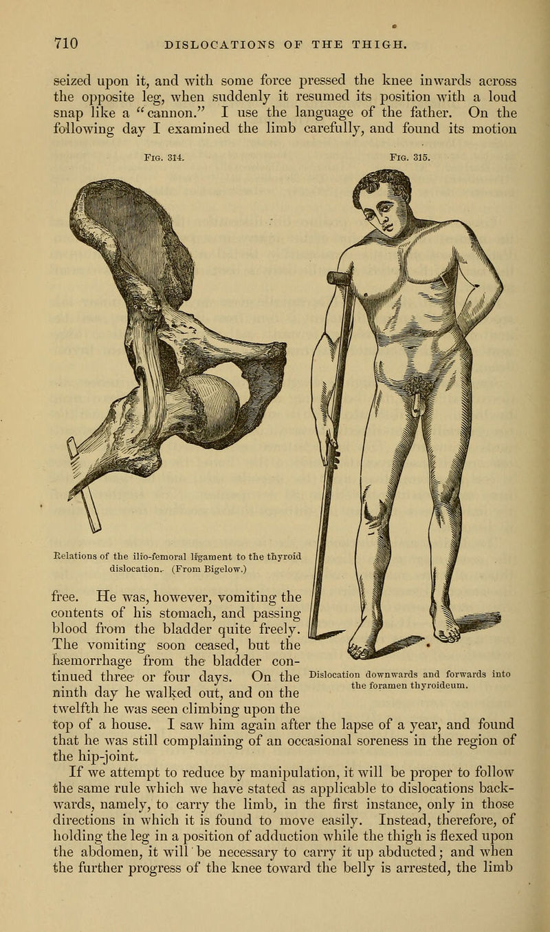 seized upon it, and with some force pressed the knee inwards across the opposite leg, when suddenly it resumed its position with a loud snap like a cannon. I use the language of the father. On the following day I examined the limb carefully, and found its motion Fig. 314. Fig. 315. Relations of the ilio-femoral ligament to the thyroid dislocation.- (From Bigelow.) free. Dislocation downwards and forwards into the foramen thyroideum. He was, however, vomiting the contents of his stomach, and passing blood from the bladder quite freely. The vomiting soon ceased, but the haemorrhage from the bladder con- tinued three or four days. On the ninth day he walked out, and on the twelfth he was seen climbing upon the top of a house. I saw him again after the lapse of a year, and found that he was still complaining of an occasional soreness in the region of the hip-joint. If we attempt to reduce by manipulation, it will be proper to follow the same rule which we have stated as applicable to dislocations back- wards, namely, to carry the limb, in the first instance, only in those directions in which it is found to move easily. Instead, therefore, of holding the leg in a position of adduction while the thigh is flexed upon the abdomen, it will be necessary to carry it up abducted; and when the further progress of the knee toward the belly is arrested, the limb