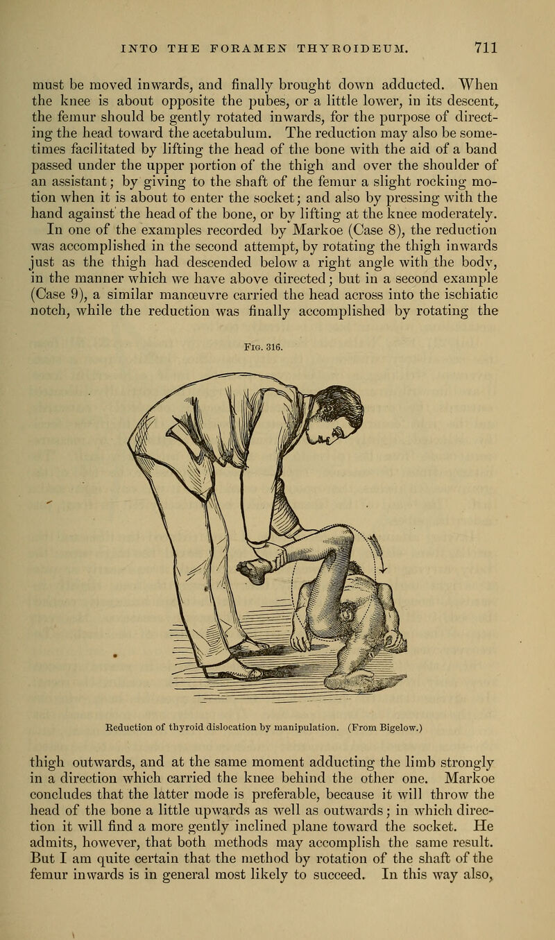 must be moved inwards, and finally brought down adducted. When the knee is about opposite the pubes, or a little lower, in its descent,, the femur should be gently rotated inwards, for the purpose of direct- ing the head toward the acetabulum. The reduction may also be some- times facilitated by lifting the head of the bone with the aid of a band passed under the upper portion of the thigh and over the shoulder of an assistant; by giving to the shaft of the femur a slight rocking mo- tion when it is about to enter the socket; and also by pressing with the hand against the head of the bone, or by lifting at the knee moderately. In one of the examples recorded by Markoe (Case 8), the reduction was accomplished in the second attempt, by rotating the thigh inwards just as the thigh had descended below a right angle with the body, in the manner which we have above directed; but in a second example (Case 9), a similar manoeuvre carried the head across into the ischiatic notch, while the reduction was finally accomplished by rotating the Fig. 316. Reduction of thyroid dislocation by manipulation. (From Bigelow.) thigh outwards, and at the same moment adducting the limb strongly in a direction which carried the knee behind the other one. Markoe concludes that the latter mode is preferable, because it will throw the head of the bone a little upwards as well as outwards; in which direc- tion it will find a more gently inclined plane toward the socket. He admits, however, that both methods may accomplish the same result. But I am quite certain that the method by rotation of the shaft of the femur inwards is in general most likely to succeed. In this way also,