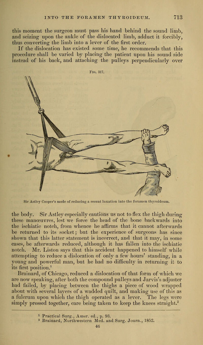 this moment the surgeon must pass his hand behind the sound limb, and seizing upon the ankle of the dislocated limb, adduct it forcibly, thus converting the limb into a lever of the first order. If the dislocation has existed some time, he recommends that this procedure shall be varied by placing the patient upon his sound side instead of his back, and attaching the pulleys perpendicularly over Fig. 317. Sir Astley Cooper's mode of reducing a recent luxation into the foramen thyroideum. the body. Sir Astley especially cautions us not to flex the thigh during these manoeuvres, lest we force the head of the bone backwards into the ischiatic notch, from whence he affirms that it cannot afterwards be returned to its socket; but the experience of surgeons has since shown that this latter statement is incorrect, and that it may, in some cases, be afterwards reduced, although it has fallen into the ischiatic notch. Mr. Liston says that this accident happened to himself while attempting to reduce a dislocation of only a few hours' standing, in a young and powerful man, but he had no difficulty in returning it to its first position.1 Brainard, of Chicago, reduced a dislocation of that form of which we are now speaking, after both the compound pulleys and Jarvis's adjuster had failed, by placing between the thighs a piece of wood wrapped about with several layers of a wadded quilt, and making use of this as a fulcrum upon which the thigh operated as a lever. The legs were simply pressed together, care being taken to keep the knees straight.2 1 Practical Surg., Amer. ed., p. 93. 2 Brainard, Northwestern Med. and Surg. Journ., 1852. 46