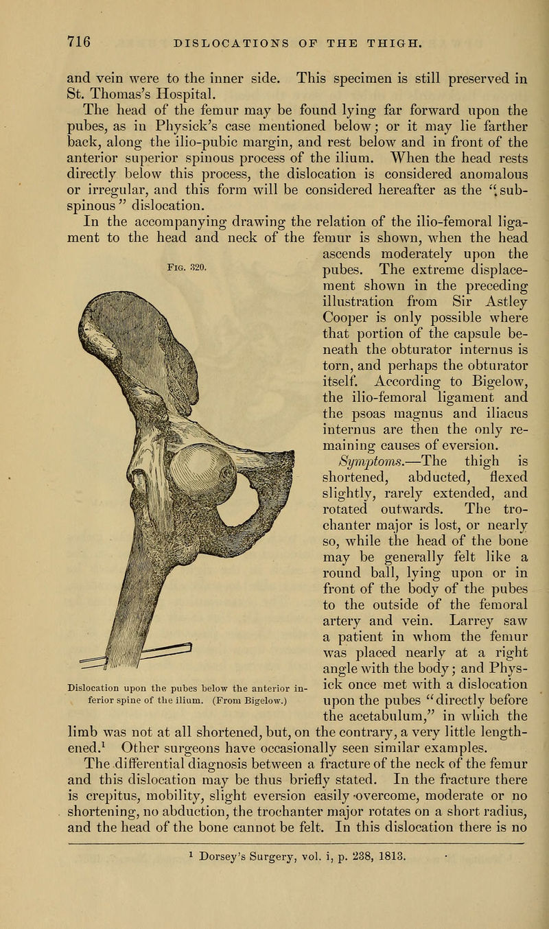 and vein were to the inner side. This specimen is still preserved in St. Thomas's Hospital. The head of the femur may be found lying far forward upon the pubes, as in Physick's case mentioned below; or it may lie farther back, along the ilio-pubic margin, and rest below and in front of the anterior superior spinous process of the ilium. When the head rests directly below this process, the dislocation is considered anomalous or irregular, and this form will be considered hereafter as the  sub- spinous  dislocation. In the accompanying drawing the relation of the ilio-femoral liga- ment to the head and neck of the femur is shown, when the head ascends moderately upon the FlG- m pubes. The extreme displace- ment shown in the preceding illustration from Sir Astley Cooper is only possible where that portion of the capsule be- neath the obturator interims is torn, and perhaps the obturator itself. According to Bigelow, the ilio-femoral ligament and the psoas magnus and iliacus internus are then the only re- maining causes of eversion. Symptoms.—The thigh is shortened, abducted, flexed slightly, rarely extended, and rotated outwards. The tro- chanter major is lost, or nearly so, while the head of the bone may be generally felt like a round ball, lying upon or in front of the body of the pubes to the outside of the femoral artery and vein. Larrey saw a patient in whom the femur was placed nearly at a right angle with the body; and Phys- ick once met with a dislocation upon the pubes directly before the acetabulum, in which the limb was not at all shortened, but, on the contrary, a very little length- ened.1 Other surgeons have occasionally seen similar examples. The differential diagnosis between a fracture of the neck of the femur and this dislocation may be thus briefly stated. In the fracture there is crepitus, mobility, slight eversion easily -overcome, moderate or no shortening, no abduction, the trochanter major rotates on a short radius, and the head of the bone cannot be felt. In this dislocation there is no Dislocation upon the pubes below the anterior in ferior spine of the ilium. (From Bigelow.) Dorsey's Surgery, vol. i, p. 238, 1813.