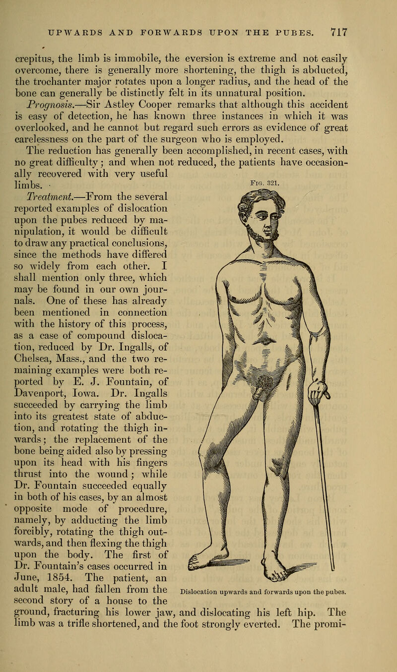 crepitus, the limb is immobile, the eversion is extreme and not easily- overcome, there is generally more shortening, the thigh is abducted, the trochanter major rotates upon a longer radius, and the head of the bone can generally be distinctly felt in its unnatural position. Prognosis.—Sir Astley Cooper remarks that although this accident is easy of detection, he has known three instances in which it was overlooked, and he cannot but regard such errors as evidence of great carelessness on the part of the surgeon who is employed. The reduction has generally been accomplished, in recent cases, with no great difficulty; and when not reduced, the patients have occasion- ally recovered with very useful limbs. ■ FlG- 32i- Treatment.—From the several reported examples of dislocation upon the pubes reduced by ma- nipulation, it would be difficult to draw any practical conclusions, since the methods have differed so widely from each other. I shall mention only three, which may be found in our own jour- nals. One of these has already been mentioned in connection with the history of this process, as a case of compound disloca- tion, reduced by Dr. Ingalls, of Chelsea, Mass., and the two re- maining examples were both re- ported by E. J. Fountain, of Davenport, Iowa. Dr. Ingalls succeeded by carrying the limb into its greatest state of abduc- tion, and rotating the thigh in- wards; the replacement of the bone being aided also by pressing upon its head with his fingers thrust into the wound; while Dr. Fountain succeeded equally in both of his cases, by an almost opposite mode of procedure, namely, by adducting the limb forcibly, rotating the thigh out- wards, and then flexing the thigh upon the body. The first of Dr. Fountain's cases occurred in June, 1854. The patient, an adult male, had fallen from the second story of a house to the ground, fracturing his lower jaw, and dislocating his left hip. The limb was a trifle shortened, and. the foot strongly everted. The promi- Dislocation upwards and forwards upon the pubes.