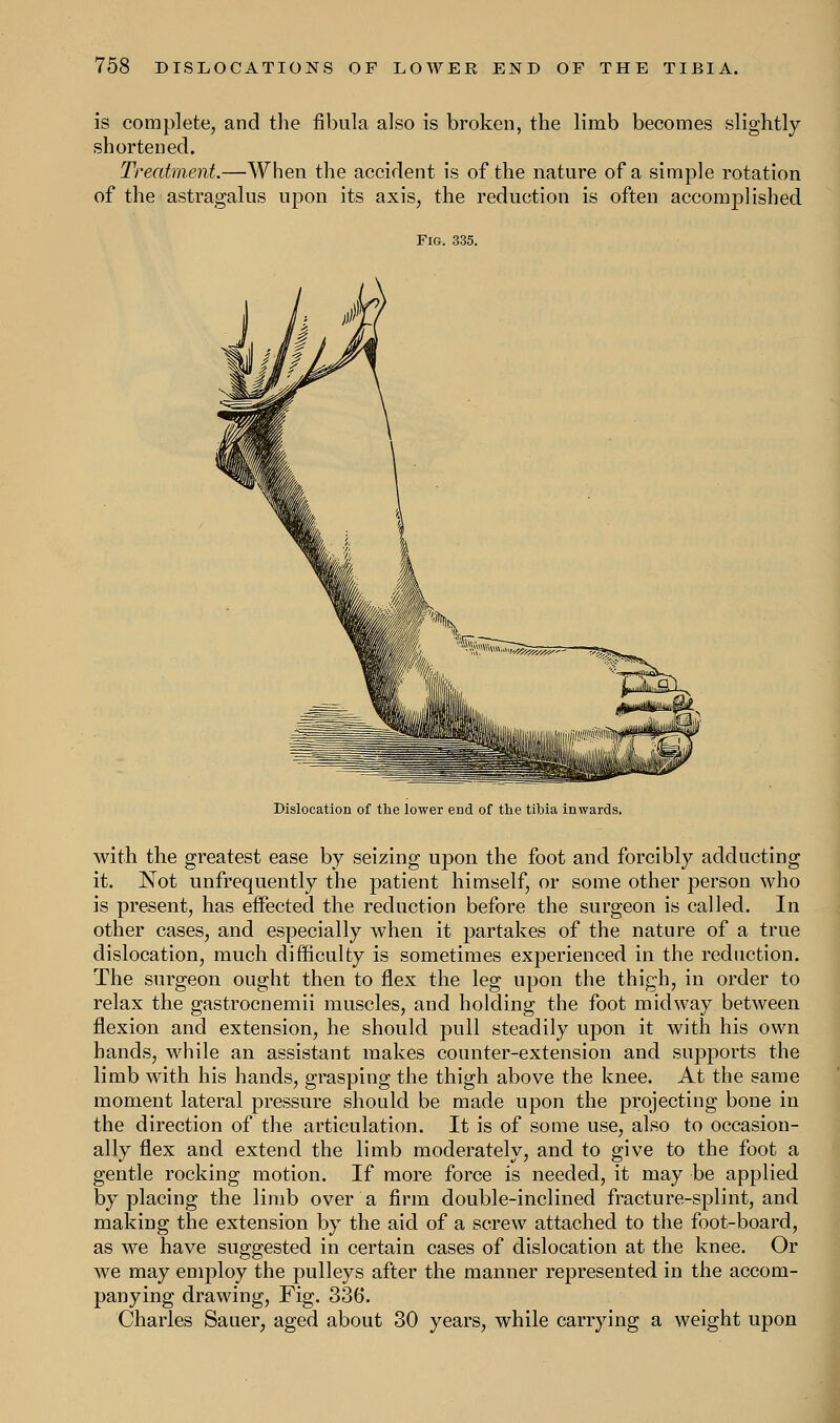 is complete, and the fibula also is broken, the limb becomes slightly shortened. Treatment.—When the accident is of the nature of a simple rotation of the astragalus upon its axis, the reduction is often accomplished Dislocation of the lower end of the tibia inwards. with the greatest ease by seizing upon the foot and forcibly adducting it. Not unfrequently the patient himself, or some other person who is present, has effected the reduction before the surgeon is called. In other cases, and especially when it partakes of the nature of a true dislocation, much difficulty is sometimes experienced in the reduction. The surgeon ought then to flex the leg upon the thigh, in order to relax the gastrocnemii muscles, and holding the foot midway between flexion and extension, he should pull steadily upon it with his own hands, while an assistant makes counter-extension and supports the limb with his hands, grasping the thigh above the knee. At the same moment lateral pressure should be made upon the projecting bone in the direction of the articulation. It is of some use, also to occasion- ally flex and extend the limb moderately, and to give to the foot a gentle rocking motion. If more force is needed, it may be applied by placing the limb over a firm double-inclined fracture-splint, and making the extension by the aid of a screw attached to the foot-board, as we have suggested in certain cases of dislocation at the knee. Or we may employ the pulleys after the manner represented in the accom- panying drawing, Fig. 336. Charles Sauer, aged about 30 years, while carrying a weight upon