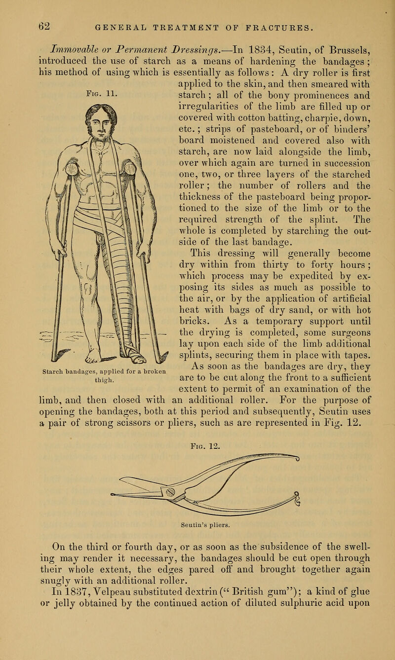 Fig. 11. Immovable or Permanent Dressings.—In 1834, Seutin, of Brussels, introduced the use of starch as a means of hardening the bandages ; his method of using which is essentially as follows : A dry roller is first applied to the skin, and then smeared with starch ; all of the bony prominences and irregularities of the limb are filled up or covered with cotton batting, charpie, down, etc.; strips of pasteboard, or of binders' board moistened and covered also with starch, are now laid alongside the limb, over which again are turned in succession one, two, or three layers of the starched roller; the number of rollers and the thickness of the pasteboard being propor- tioned to the size of the limb or to the required strength of the splint. The whole is completed by starching the out- side of the last bandage. This dressing will generally become dry within from thirty to forty hours ; which process may be expedited by ex- posing its sides as much as possible to the air, or by the application of artificial heat with bags of dry sand, or with hot bricks. As a temporary support until the drying is completed, some surgeons lay upon each side of the limb additional splints, securing them in place with tapes. As soon as the bandages are dry, they are to be cut along the front to a sufficient extent to permit of an examination of the limb, and then closed with an additional roller. For the purpose of opening the bandages, both at this period and subsequently, Seutin uses a pair of strong scissors or pliers, such as are represented in Fig. 12. Starch bandages, applied for a broken thigh. Fig. 12. Seutin's pliers. On the third or fourth day, or as soon as the subsidence of the swell- ing may render it necessary, the bandages should be cut open through their whole extent, the edges pared off and brought together again snugly with an additional roller. In 1837, Velpeau substituted dextrin ( British gum); a kind of glue or jelly obtained by the continued action of diluted sulphuric acid upon