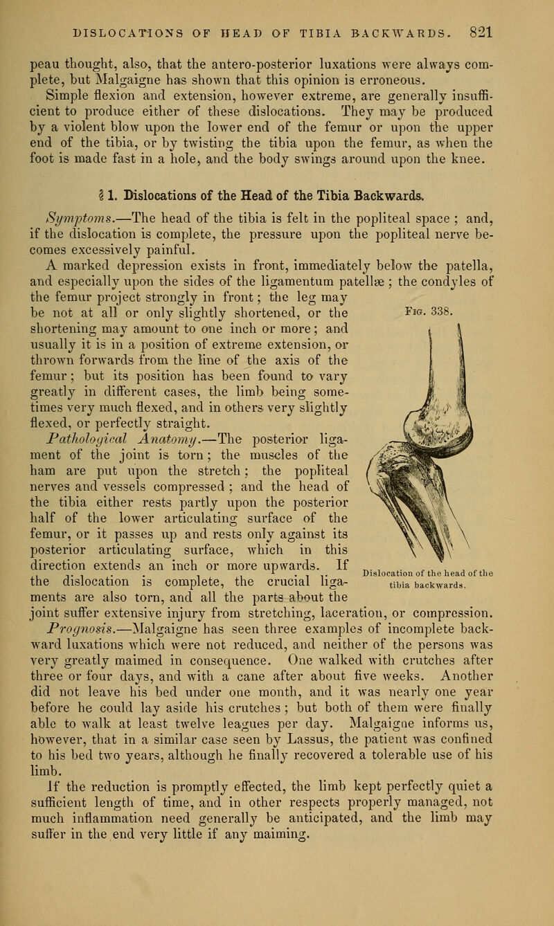 peau thought, also, that the antero-posterior luxations were always com- plete, but Malgaigne has shown that this opinion is erroneous. Simple flexion and extension, however extreme, are generally insuffi- cient to produce either of these dislocations. They may be produced by a violent blow upon the lower end of the femur or upon the upper end of the tibia, or by twisting the tibia upon the femur, as when the foot is made fast in a hole,, and the body swings around upon the knee. Fig. 338. \ 1. Dislocations of the Head of the Tibia Backwards. Symptoms.—The head of the tibia is felt in the popliteal space ; and, if the dislocation is complete, the pressure upon the popliteal nerve be- comes excessively painful. A marked depression exists in front, immediately below the patella, and especially upon the sides of the ligamentum patellae ; the condyles of the femur project strongly in front; the leg may be not at all or only slightly shortened, or the shortening may amount to one inch or more; and usually it is in a position of extreme extension, or thrown forwards from the line of the axis of the femur; but its position has been found to vary greatly in different cases, the limb being some- times very much flexed, and in others very slightly flexed, or perfectly straight. Pathological Anatomy.—The posterior liga- ment of the joint is torn; the muscles of the ham are put upon the stretch; the popliteal nerves and vessels compressed ; and the head of the tibia either rests partly upon the posterior half of the lower articulating surface of the femur, or it passes up and rests only against its posterior articulating surface, which in this direction extends an inch or more upwards. If the dislocation is complete, the crucial liga- ments are also torn, and all the parts about the joint suffer extensive injury from stretching, laceration, or compression. Prognosis.—Malgaigne has seen three examples of incomplete back- ward luxations which were not reduced, and neither of the persons was very greatly maimed in consequence. One walked with crutches after three or four days, and with a cane after about five weeks. Another did not leave his bed under one month, and it was nearly one year before he could lay aside his crutches ; but both of them were finally able to walk at least twelve leagues per day. Malgaigne informs us, however, that in a similar case seen by Lassus, the patient was confined to his bed two years, although he finally recovered a tolerable use of his limb. If the reduction is promptly effected, the limb kept perfectly quiet a sufficient length of time, and in other respects properly managed, not much inflammation need generally be anticipated, and the limb may suffer in the end very little if any maiming. Dislocation of the head of the tibia backwards.