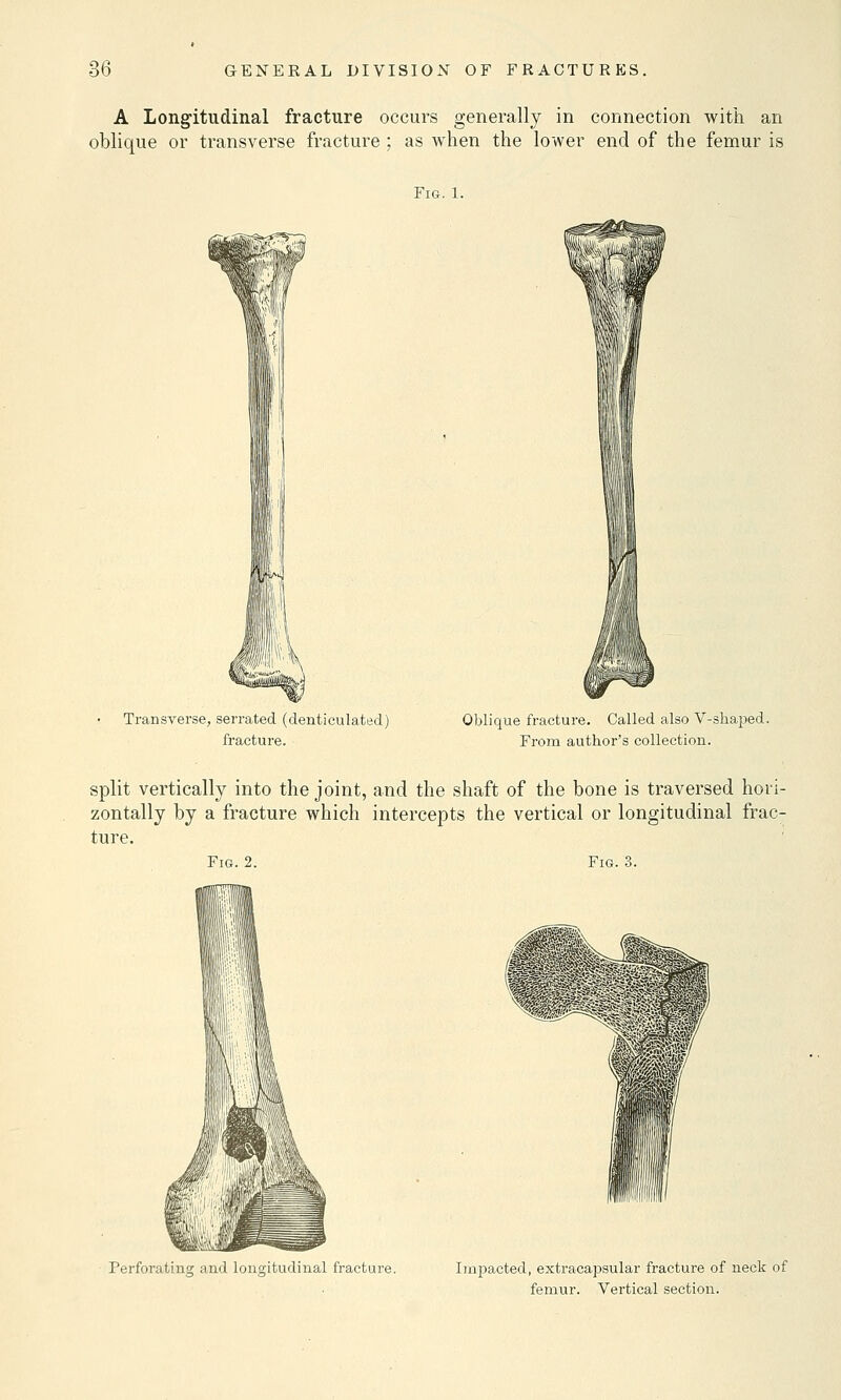 A Longitudinal fracture occurs generally in connection with an oblique or transverse fracture ; as when the lower end of the femur is Fig. 1. ^W n Transverse, serrated (denticulated) fracture. Oblique fracture. Called also V-skaped. From autkor's collection. split vertically into the joint, and the shaft of the bone is traversed hori- zontally by a fracture which intercepts the vertical or longitudinal frac- ture. Fig. 2. WB Fig. Perforating and longitudinal fracture. Impacted, extracapsular fracture of neck of femur. Vertical section.