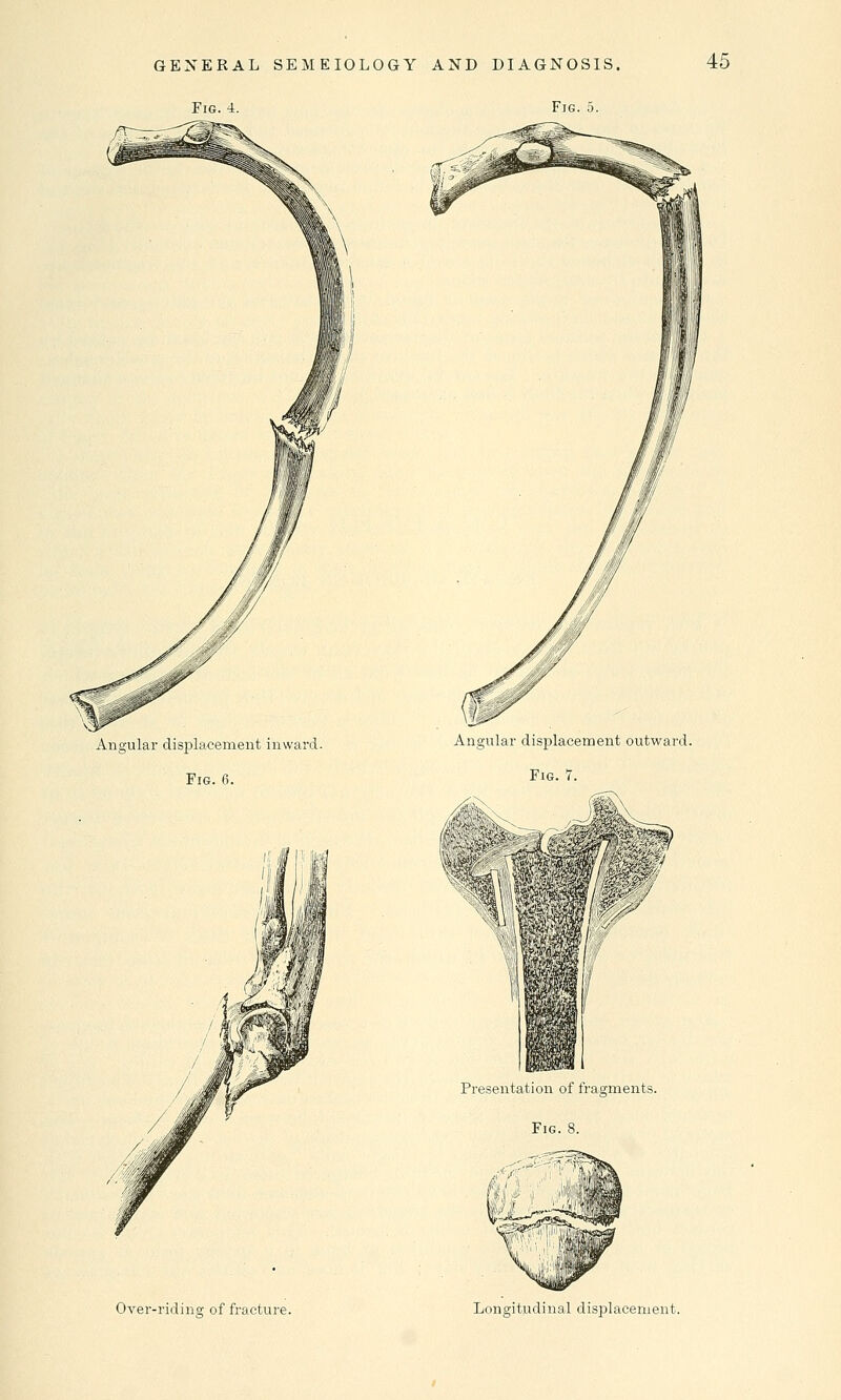 Fig. 4. Fig. 5. Angular displacement inward. Fig. 6. Angular displacement outward. Fig. 7. Hr ii ■ Presentation of fragments. Fig. 8. Over-riding of fracture. Longitudinal displacement.