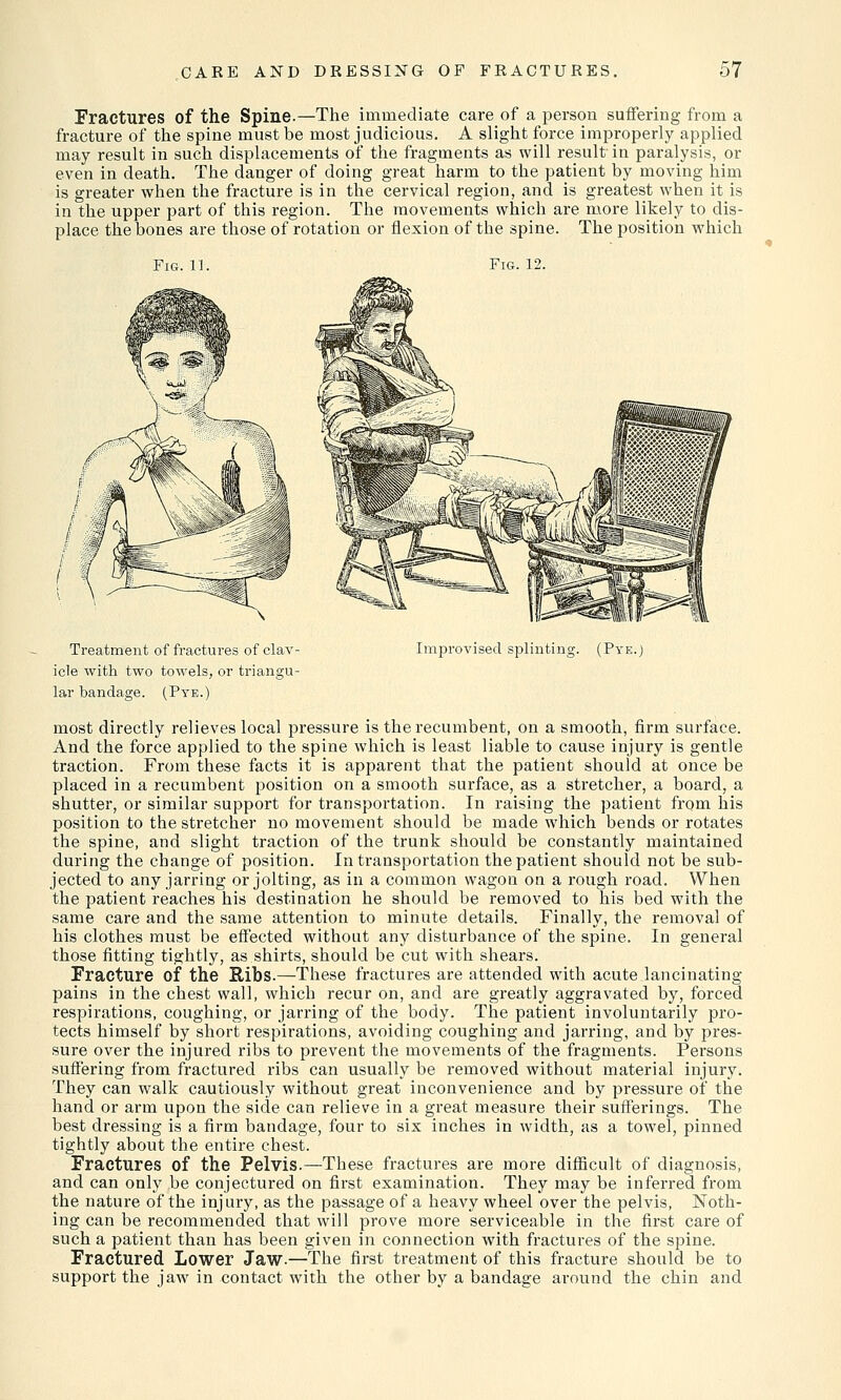 Fractures of the Spine.—The immediate care of a person suffering from a fracture of the spine must be most judicious. A slight force improperly applied may result in such displacements of the fragments as will result in paralysis, or even in death. The danger of doing great harm to the patient by moving him is greater when the fracture is in the cervical region, and is greatest when it is in the upper part of this region. The movements which are more likely to dis- place the bones are those of rotation or flexion of the spine. The position which Fig. 11. Fig. 12. Treatment of fractures of clav- icle with two towels, or triangu- lar bandage. (Pye.) Improvised splinting. (Pye.) most directly relieves local pressure is the recumbent, on a smooth, firm surface. And the force applied to the spine which is least liable to cause injury is gentle traction. From these facts it is apparent that the patient should at once be placed in a recumbent jjosition on a smooth surface, as a stretcher, a board, a shutter, or similar support for transpoi'tation. In raising the patient from his position to the stretcher no movement should be made which bends or rotates the spine, and slight traction of the trunk should be constantly maintained during the change of position. In transportation the patient should not be sub- jected to any jarring or jolting, as in a common wagon on a rough road. When the patient reaches his destination he should be removed to his bed with the same care and the same attention to minute details. Finally, the removal of his clothes must be effected without any disturbance of the spine. In general those fitting tightly, as shirts, should be cut with shears. Fracture of the Ribs.—These fractures are attended with acute lancinating pains in the chest wall, which recur on, and are greatly aggravated by, forced respirations, coughing, or jarring of the body. The patient involuntarily pro- tects himself by short respirations, avoiding coughing and jarring, and by pres- sure over the injured ribs to prevent the movements of the fragments. Persons suffering from fractured ribs can usually be removed without material injury. They can walk cautiously without great inconvenience and by pressure of the hand or arm upon the side can relieve in a great measure their sufferings. The best dressing is a firm bandage, four to six inches in width, as a towel, pinned tightly about the entire chest. Fractures of the Pelvis.—These fractures are more difficult of diagnosis, and can only be conjectured on first examination. They may be inferred from the nature of the injury, as the passage of a heavy wheel over the pelvis, Noth- ing can be recommended that will prove more serviceable in the first care of such a patient than has been given in connection with fractures of the spine. Fractured Lower Jaw.—The first treatment of this fracture should be to support the jaw in contact with the other by a bandage around the chin and