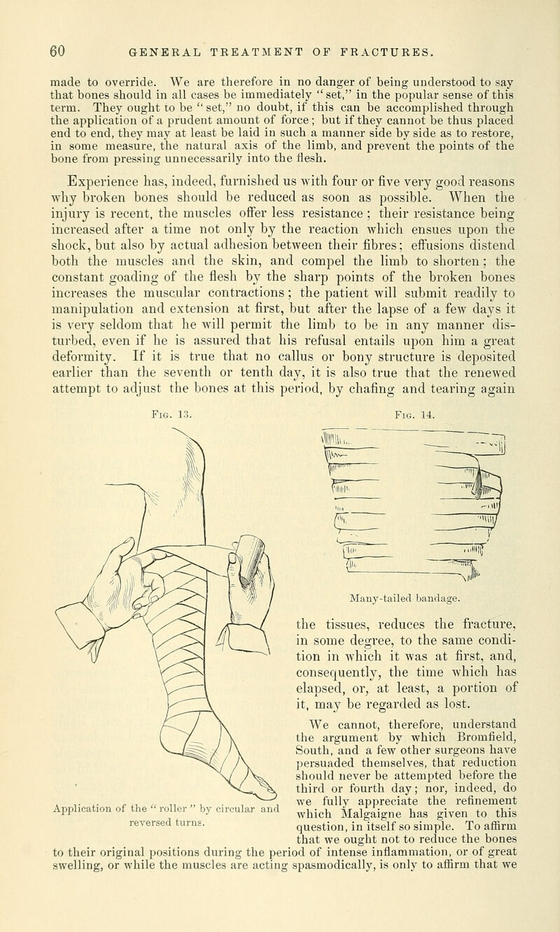 made to override. We are therefore in no danger of being understood to say that bones should in all cases be immediately set, in the popular sense of this term. They ought to be  set, no doubt, if this can be accomplished through the application of a prudent amount of force; but if they cannot be thus placed end to end, they may at least be laid in such a manner side by side as to restore, in some measure, the natural axis of the limb, and prevent the points of the bone from pressing unnecessarily into the flesh. Experience has, indeed, furnished us with four or five very good reasons why broken bones should be reduced as soon as possible. When the injury is recent, the muscles offer less resistance ; their resistance being increased after a time not only by the reaction which ensues upon the shock, but also by actual adhesion between their fibres; effusions distend both the muscles and the skin, and compel the limb to shorten; the constant goading of the flesh by the sharp points of the broken bones increases the muscular contractions; the patient will submit readily to manipulation and extension at first, but after the lapse of a few days it is very seldom that he will permit the limb to be in any manner dis- turbed, even if he is assured that his refusal entails upon him a great deformity. If it is true that no callus or bony structure is deposited earlier than the seventh or tenth day, it is also true that the renewed attempt to adjust the bones at this period, by chafing and tearing again Fig. 13. Fig. 14. Many-tailed bandage. the tissues, reduces the fracture, in some degree, to the same condi- tion in which it was at first, and, consequently, the time which has elapsed, or, at least, a portion of it, may be regarded as lost. We cannot, therefore, understand the argument by which Bromfield, South, and a few other surgeons have persuaded themselves, that reduction should never be attempted before the third or fourth day; nor, indeed, do we fully appreciate the refinement which Malgaigne has given to this question, in itself so simple. To affirm that we ought not to reduce the bones to their original positions during the period of intense inflammation, or of great swelling, or while the muscles are acting spasmodically, is only to affirm that we Application of the  roller  by circular and reversed turns.