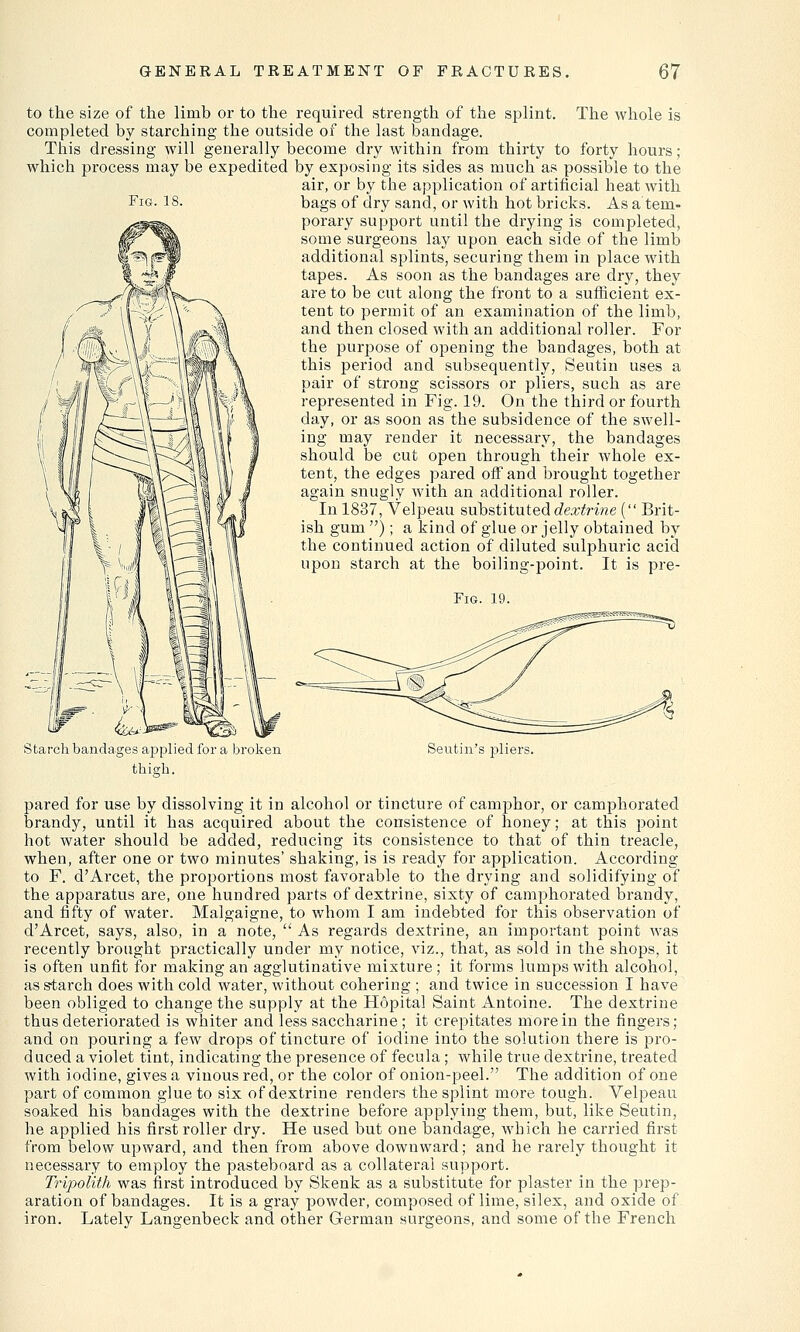 Fig. 18. to the size of the limb or to the required strength of the splint. The whole is completed by starching the outside of the last bandage. This dressing will generally become dry within from thirty to forty hours; which process may be expedited by exposing its sides as much as possible to the air, or by the application of artificial heat with bags of dry sand, or with hot bricks. As a tem- porary support until the drying is completed, some surgeons lay upon each side of the limb additional splints, securing them in place with tapes. As soon as the bandages are dry, they are to be cut along the front to a sufficient ex- tent to permit of an examination of the limb, and then closed with an additional roller. For the purpose of opening the bandages, both at this period and subsequently, Seutin uses a pair of strong scissors or pliers, such as are represented in Fig. 19. On the third or fourth day, or as soon as the subsidence of the swell- ing may render it necessary, the bandages should be cut open through their whole ex- tent, the edges pared off and brought together again snugly with an additional roller. In 1837, Velpeau substituted dextrine ( Brit- ish gum ); a kind of glue or jelly obtained by the continued action of diluted sulphuric acid upon starch at the boiling-point. It is pre- Fig. 19. Starch bandages applied for a broken thigh. Seutin's pliers. pared for use by dissolving it in alcohol or tincture of camphor, or camphorated brandy, until it has acquired about the consistence of honey; at this point hot water should be added, reducing its consistence to that of thin treacle, when, after one or two minutes' shaking, is is ready for application. According to F. d'Arcet, the proportions most favorable to the drying and solidifying of the apparatus are, one hundred parts of dextrine, sixty of camphorated brandy, and fifty of water. Malgaigne, to whom I am indebted for this observation of d'Arcet, says, also, in a note,  As regards dextrine, an important point was recently brought practically under my notice, viz., that, as sold in the shops, it is often unfit for making an agglutinative mixture; it forms lumps with alcohol, as starch does with cold water, without cohering ; and twice in succession I have been obliged to change the supply at the Hopital Saint Antoine. The dextrine thus deteriorated is whiter and less saccharine ; it crepitates more in the fingers; and on pouring a few drops of tincture of iodine into the solution there is pro- duced a violet tint, indicating the presence of fecula; while true dextrine, treated with iodine, gives a vinous red, or the color of onion-peel. The addition of one part of common glue to six of dextrine renders the splint more tough. Velpeau soaked his bandages with the dextrine before applying them, but, like Seutin, he applied his first roller dry. He used but one bandage, which he carried first from below upward, and then from above downward; and he rarely thought it necessary to employ the pasteboard as a collateral support. Tripolith was first introduced by Skenk as a substitute for plaster in the prep- aration of bandages. It is a gray powder, composed of lime, silex, and oxide of iron. Lately Langenbeck and other German surgeons, and some of the French