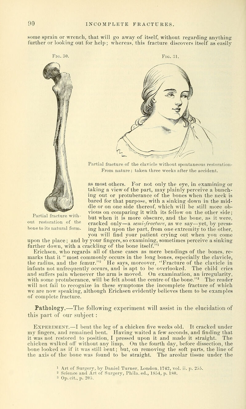 some sprain or wrench, that will go away of itself, without regarding anything further or looking out for help; whereas, this fracture discovers itself as easily Fig. 30. Fig. 31. Partial fracture with- out restoration of the bone to its natural form. Partial fracture of the clavicle without spontaneous restoration- From nature; taken three weeks after the accident. as most others. For not only the eye, in examining or taking a view of the part, may plainly perceive a bunch- ing out or protuberance of the bones when the neck is bared for that purpose, with a sinking down in the mid- dle or on one side thereof, which will be still more ob- vious on comparing it with its fellow on the other side; but when it is more obscure, and the bone, as it were, cracked only—a semi-fracture, as we say—yet, by press- ing hard upon the part, from one extremity to the other, you will find your patient crying out when you come upon the place; and by your fingers, so examining, sometimes perceive a sinking further down, with a crackling of the bone itself.1 Erichsen, who regards all of these cases as mere bendings of the bones, re- marks that it  most commonly occurs in the long bones, especially the clavicle, the radius, and the femur.2 He says, moreover, Fracture of the clavicle in infants not unfrequently occurs, and is apt to be overlooked. The child cries and suffers pain whenever the arm is moved. On examination, an irregularity, with some protuberance, will be felt about the centre of the bone.3 The reader will not fail to recognize in these symptoms the incomplete fracture of which we are now speaking, although Erichsen evidently believes them to be examples of complete fracture. Pathology.—The following experiment will assist in the elucidation of this part of our subject: Experiment.—I bent the leg of a chicken five weeks old. It cracked under my fingers, and remained bent. Having waited a few seconds, and finding that it was not restored to position, I pressed upon it and made it straight. The chicken walked off without any limp. On the fourth day, before dissection, the bone looked as if it was still bent; but, on removing the soft parts, the line of the axis of the bone was found to be straight. The areolar tissue under the 1 Art of Surgery, by Daniel Turner, London, 1742, vol. ii. p. 255. 2 Science and Art of Surgery, Phila. ed., 1854, p. 180. 3 Op. cit.,p. 205.