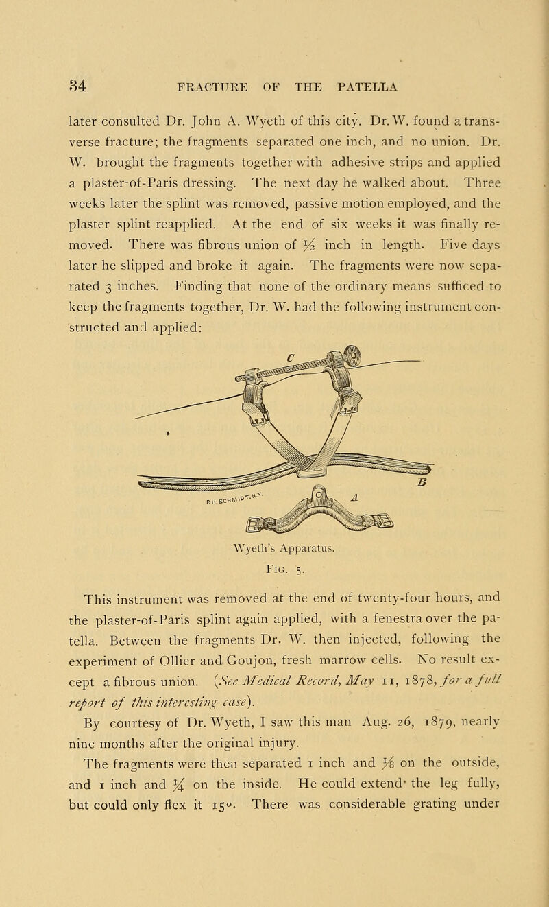 later consulted Dr. John A. Wyeth of this city. Dr. W. found a trans- verse fracture; the fragments separated one inch, and no union. Dr. W. brought the fragments together with adhesive strips and applied a plaster-of-Paris dressing. The next day he walked about. Three weeks later the splint was removed, passive motion employed, and the plaster splint reapplied. At the end of six weeks it was finally re- moved. There was fibrous union of ^2 inch in length. Five days later he slipped and broke it again. The fragments were now sepa- rated 3 inches. Finding that none of the ordinary means sufficed to keep the fragments together, Dr. W. had the following instrument con- structed and applied: Wyeth's Apparatus. Fig. 5. This instrument was removed at the end of twenty-four hours, and the plaster-of-Paris splint again applied, with a fenestra over the pa- tella. Between the fragments Dr. W. then injected, following the experiment of Oilier and Goujon, fresh marrow cells. No result ex- cept a fibrous union. [See Medical Record, May n, 1878, for a full report of this interesting case). By courtesy of Dr. Wyeth, I saw this man Aug. 26, 1879, nearly nine months after the original injury. The fragments were then separated 1 inch and }i on the outside, and 1 inch and % on the inside. He could extend* the leg fully, but could only flex it 15°. There was considerable grating under