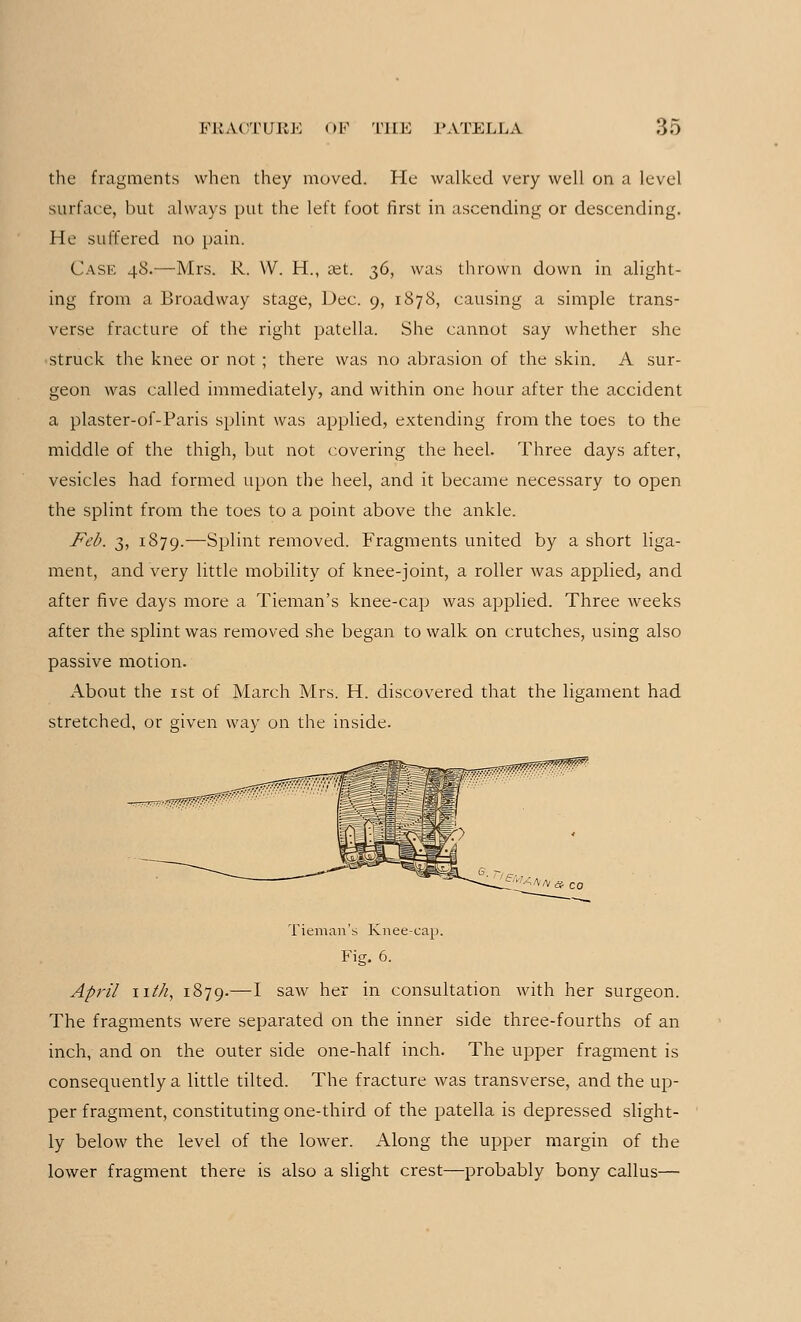 the fragments when they moved. He walked very well on a level surface, but always put the left foot first in ascending or descending. He suffered no pain. Case 48.—Mrs. R. VV. H., set. 36, was thrown down in alight- ing from a Broadway stage, Dec. 9, 1878, causing a simple trans- verse fracture of the right patella. She cannot say whether she struck the knee or not ; there was no abrasion of the skin. A sur- geon was called immediately, and within one hour after the accident a plaster-of-Paris splint was applied, extending from the toes to the middle of the thigh, but not covering the heel. Three days after, vesicles had formed upon the heel, and it became necessary to open the splint from the toes to a point above the ankle. Feb. 3, 1879.—Splint removed. Fragments united by a short liga- ment, and very little mobility of knee-joint, a roller was applied, and after five days more a Tieman's knee-cap was applied. Three weeks after the splint was removed she began to walk on crutches, using also passive motion. About the 1st of March Mrs. H. discovered that the ligament had stretched, or given way on the inside. Tieman's Knee-cap. Fig. 6. April nth, 1879.—I saw her in consultation with her surgeon. The fragments were separated on the inner side three-fourths of an inch, and on the outer side one-half inch. The upper fragment is consequently a little tilted. The fracture was transverse, and the up- per fragment, constituting one-third of the patella is depressed slight- ly below the level of the lower. Along the upper margin of the lower fragment there is also a slight crest—probably bony callus—
